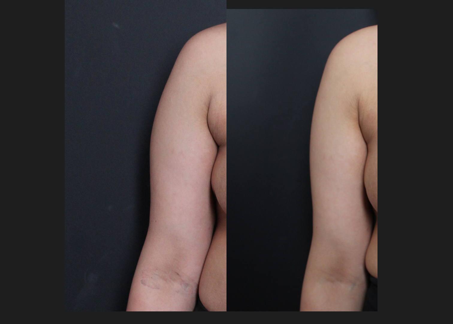 394711 Arm Axilla Lipo Renuvion right