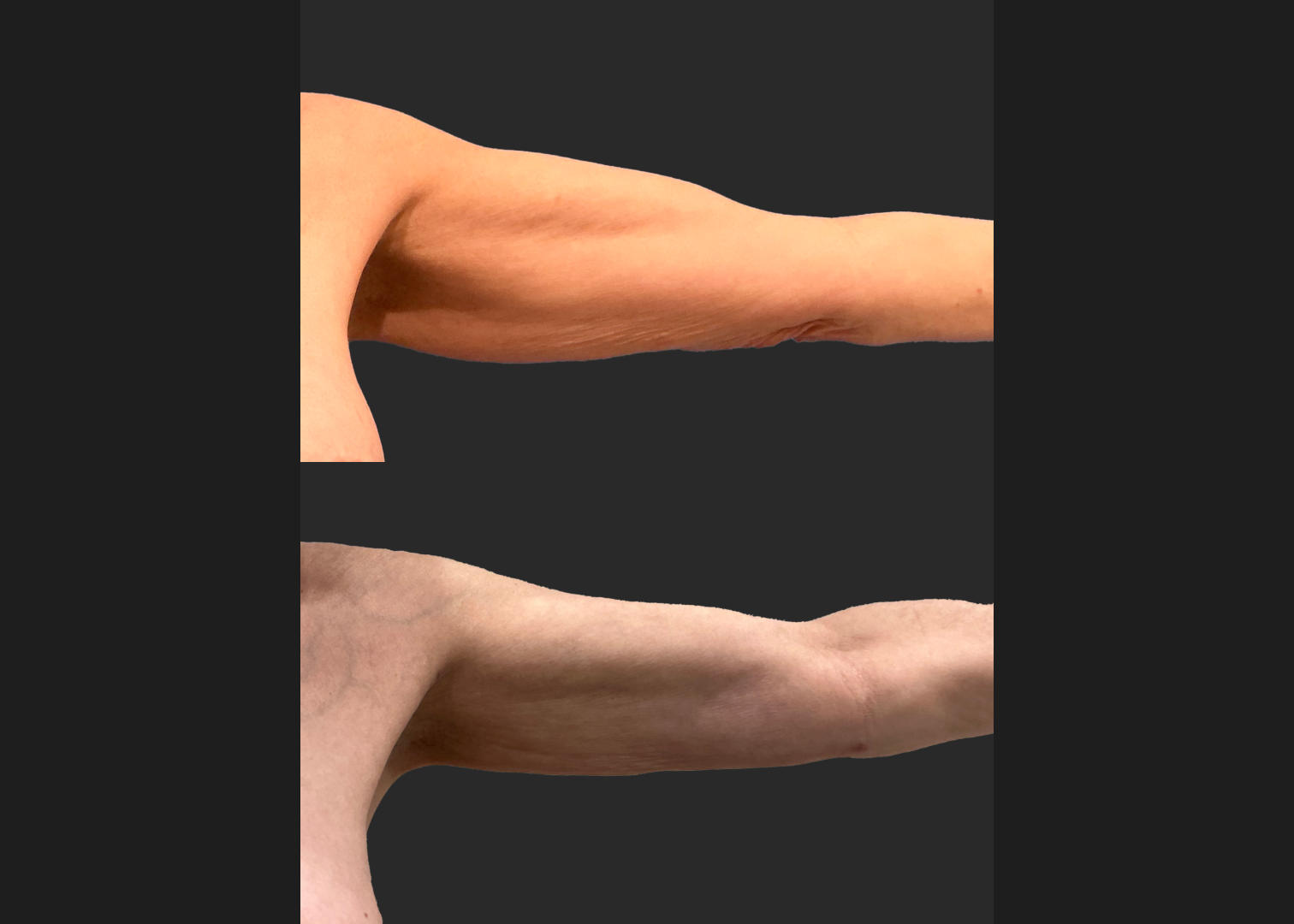 Arm Lipo Renuvion Older thin female loose skin Before After- Anterior Left