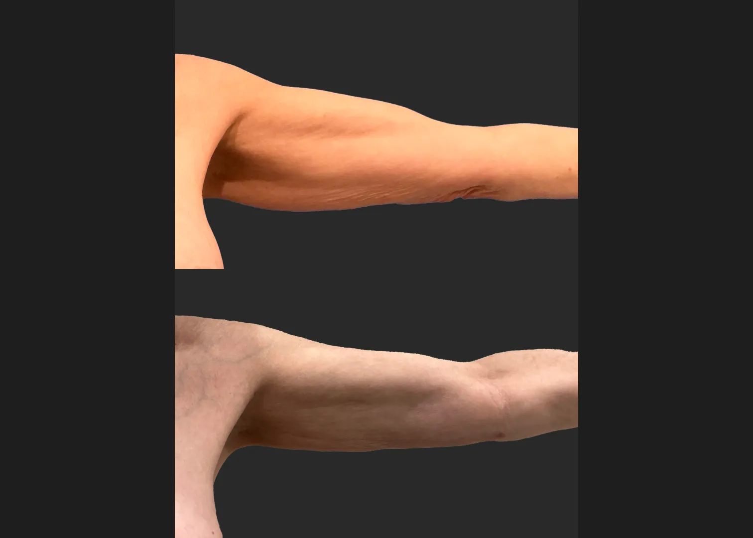Arm Lipo Renuvion Older thin female loose skin Before After- Anterior Left