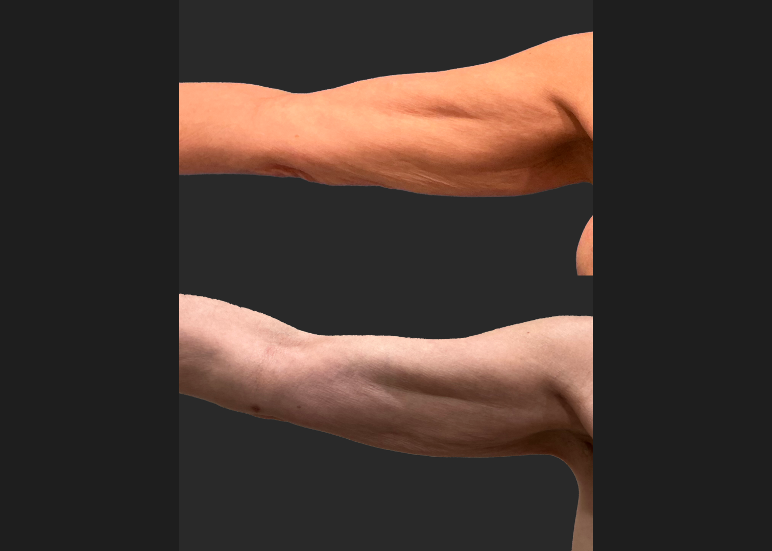 Arm Lipo Renuvion Older thin female loose skin Before After- Anterior Right