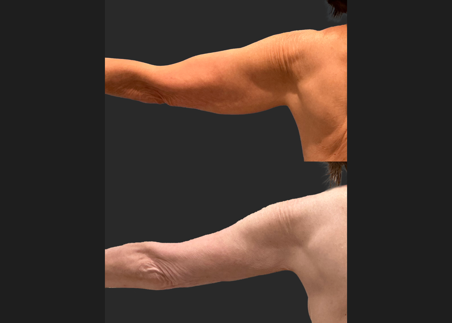 Arm Lipo Renuvion Older thin female loose skin Before After- Posterior Left