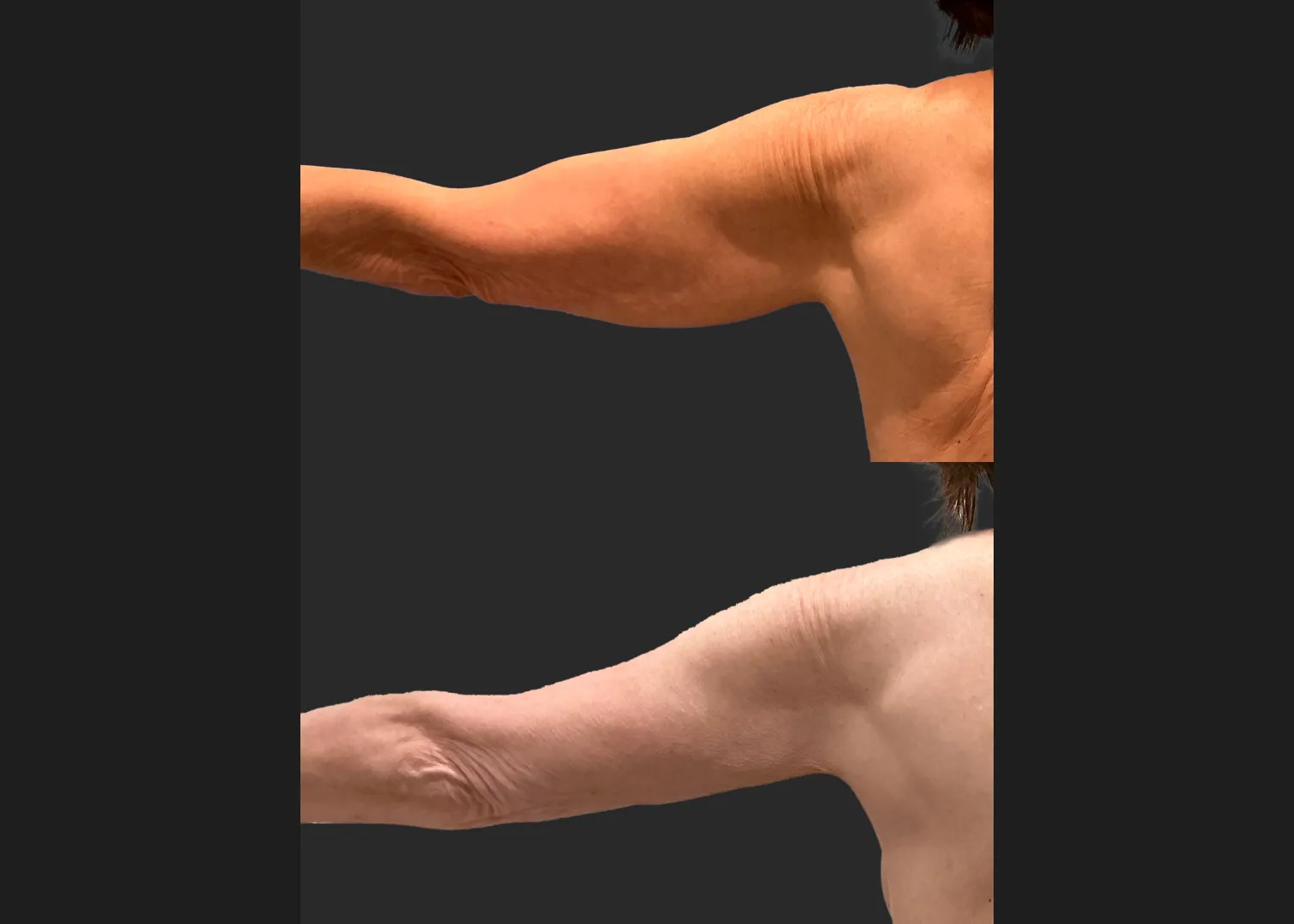 Arm Lipo Renuvion Older thin female loose skin Before After- Posterior Left
