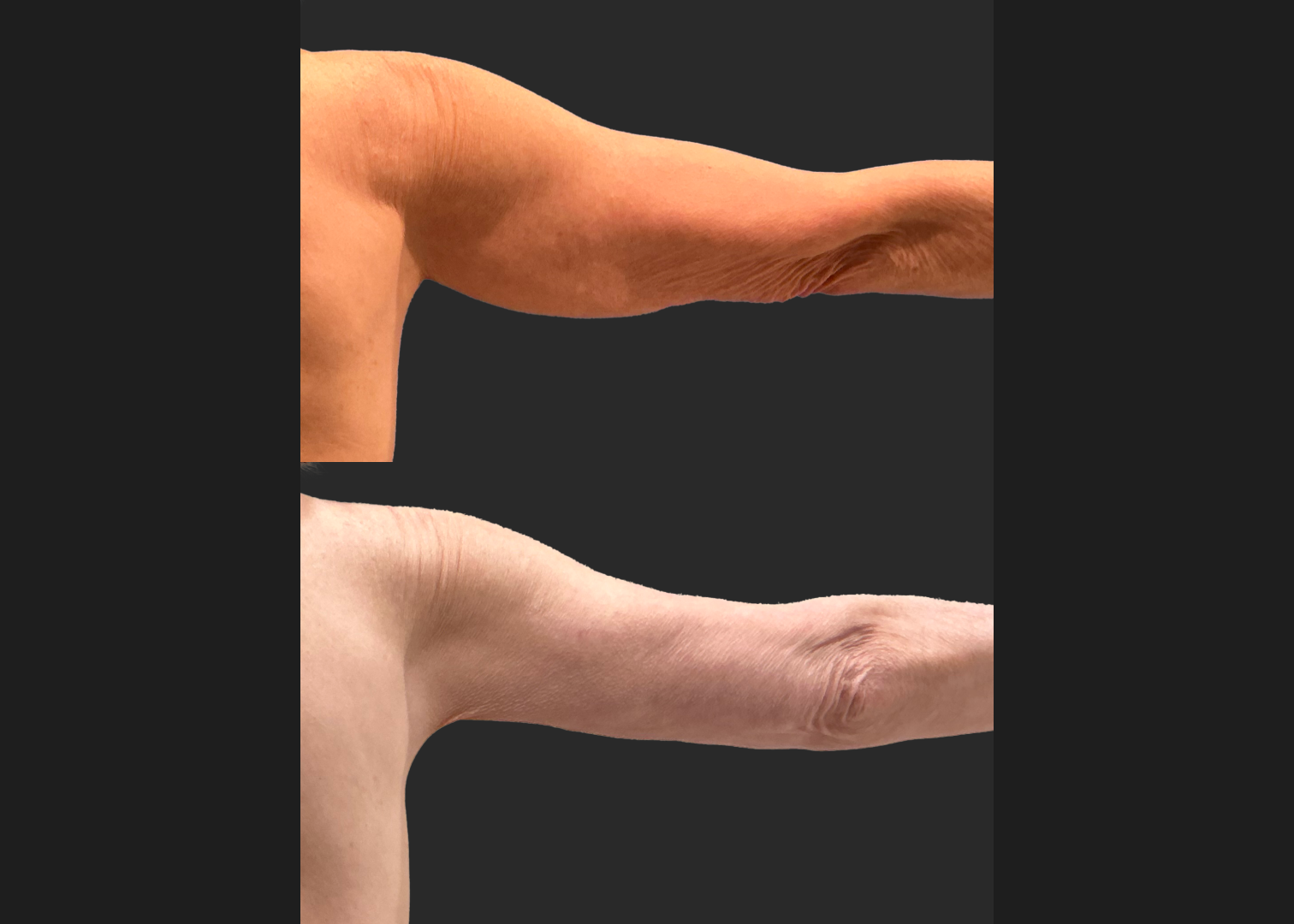 Arm Lipo Renuvion Older thin female loose skin Before After- Posterior Right