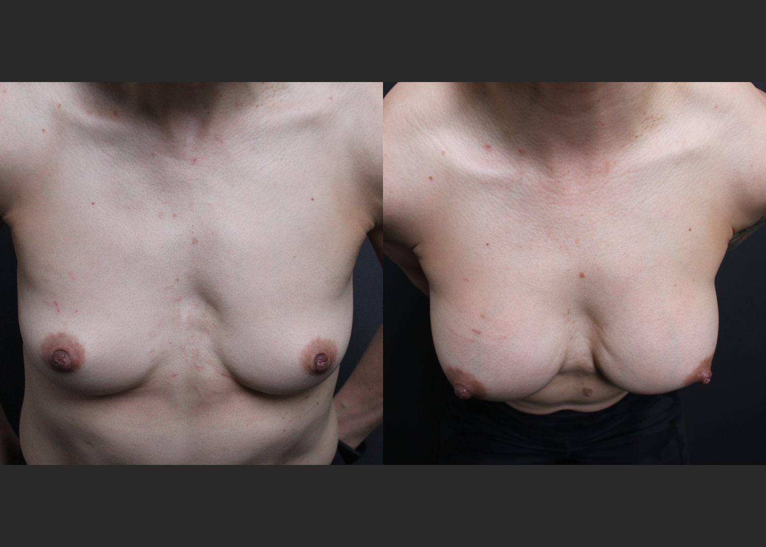 Athletic muscular female breast augmentation sientra HSC+ smooth round moderate plus silicone gel gummy bear implants 285 cc subfascial before after- cleavage