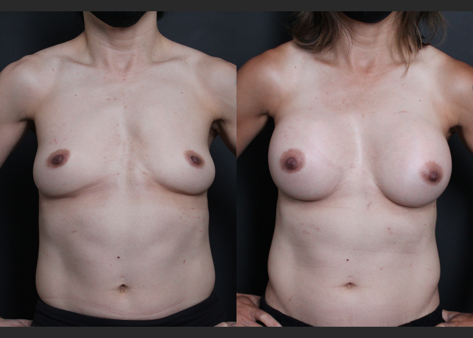 Athletic muscular female breast augmentation sientra HSC+ smooth round moderate plus silicone gel gummy bear implants 285 cc subfascial before after- flexed