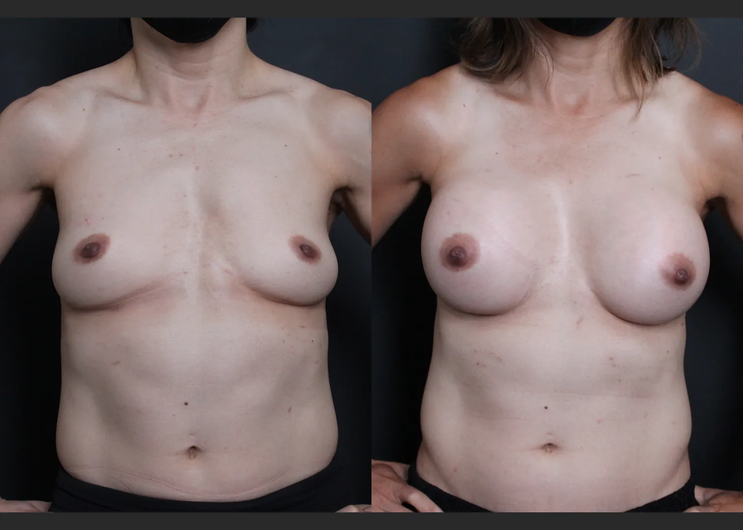 Athletic muscular female breast augmentation sientra HSC+ smooth round moderate plus silicone gel gummy bear implants 285 cc subfascial before after- flexed
