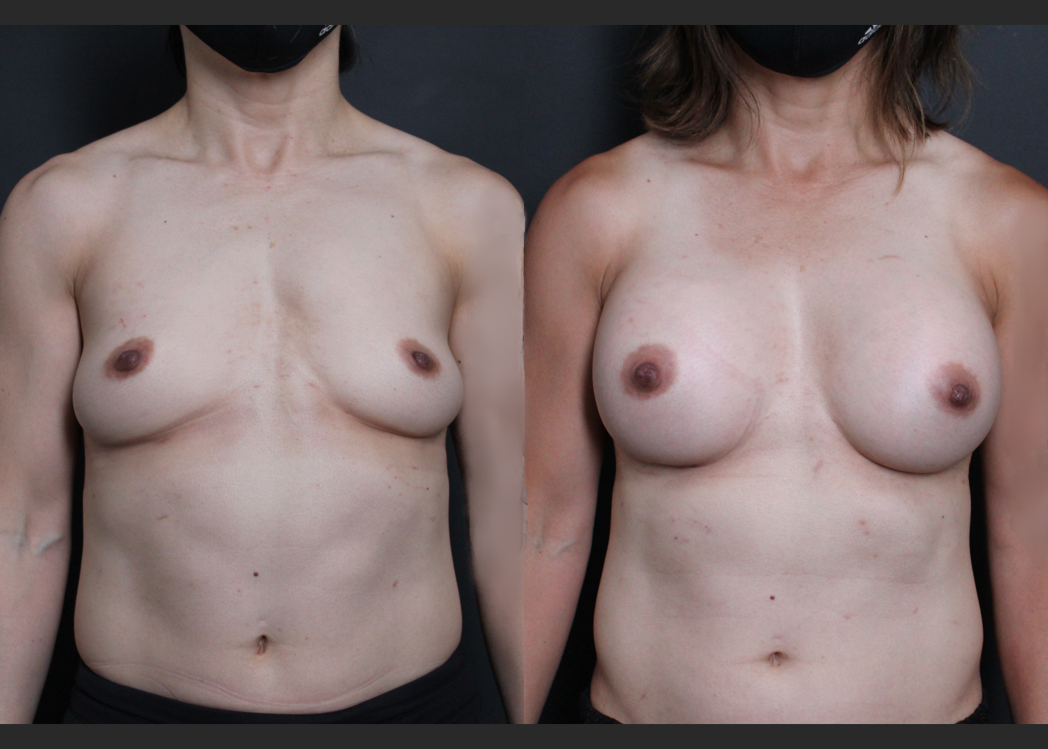 Athletic muscular female breast augmentation sientra HSC+ smooth round moderate plus silicone gel gummy bear implants 285 cc subfascial before after- front
