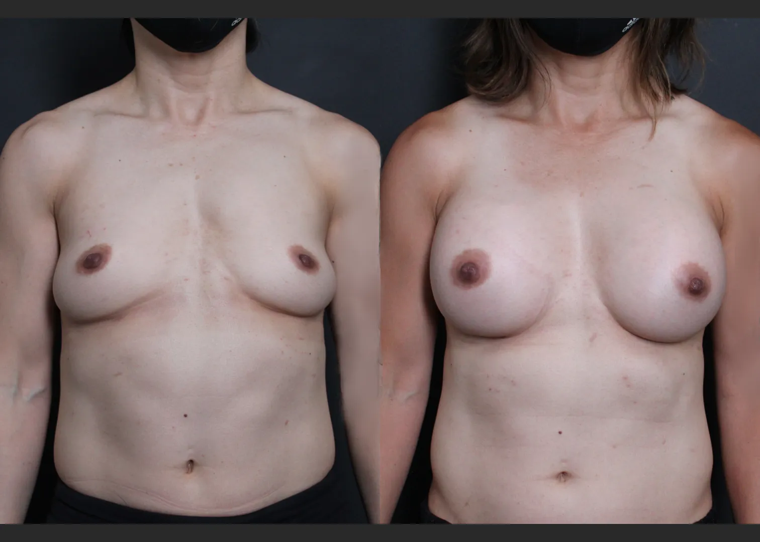 Athletic muscular female breast augmentation sientra HSC+ smooth round moderate plus silicone gel gummy bear implants 285 cc subfascial before after- front