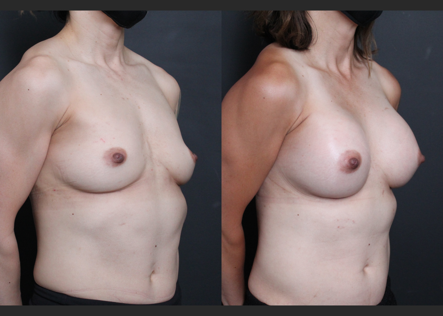 Athletic muscular female breast augmentation sientra HSC+ smooth round moderate plus silicone gel gummy bear implants 285 cc subfascial before after- right oblique