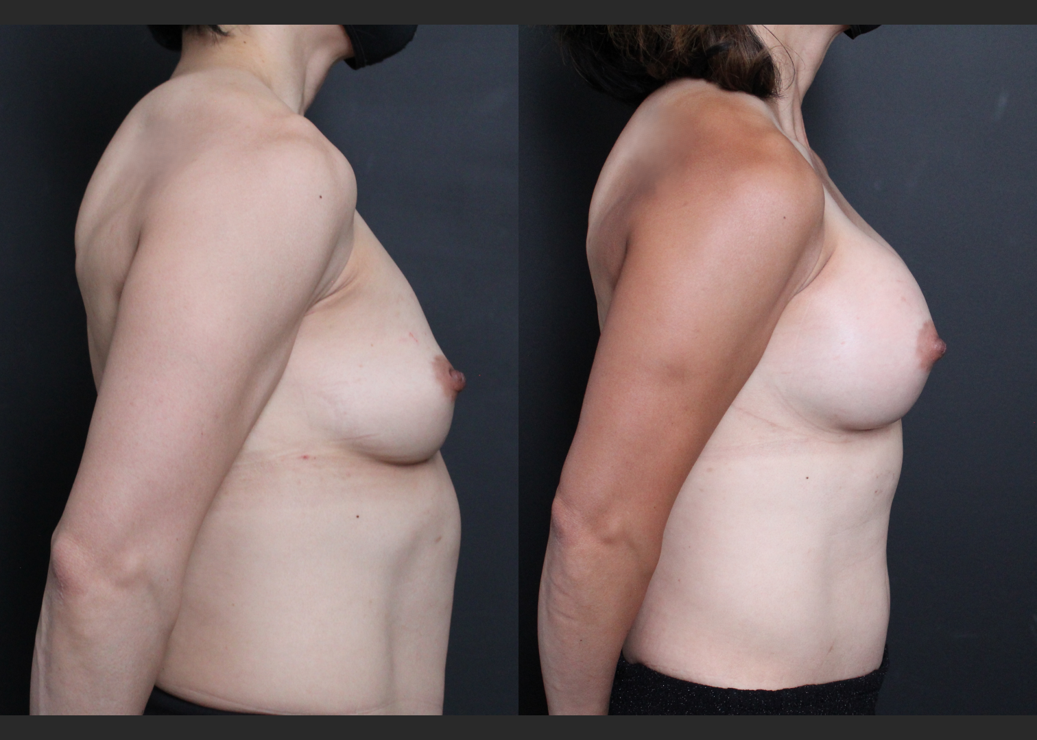Athletic muscular female breast augmentation sientra HSC+ smooth round moderate plus silicone gel gummy bear implants 285 cc subfascial before after- right