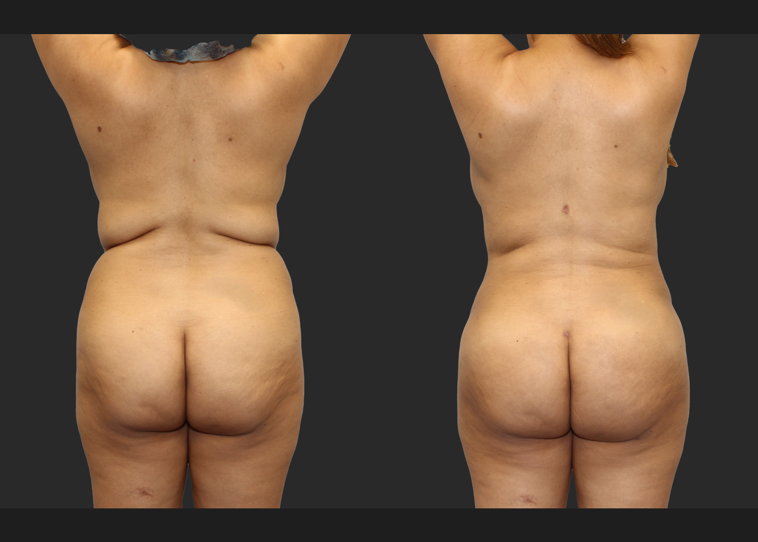 Back Arm Lipo Renuvion BBL Fat transfer to buttocks Before After – Back arms up