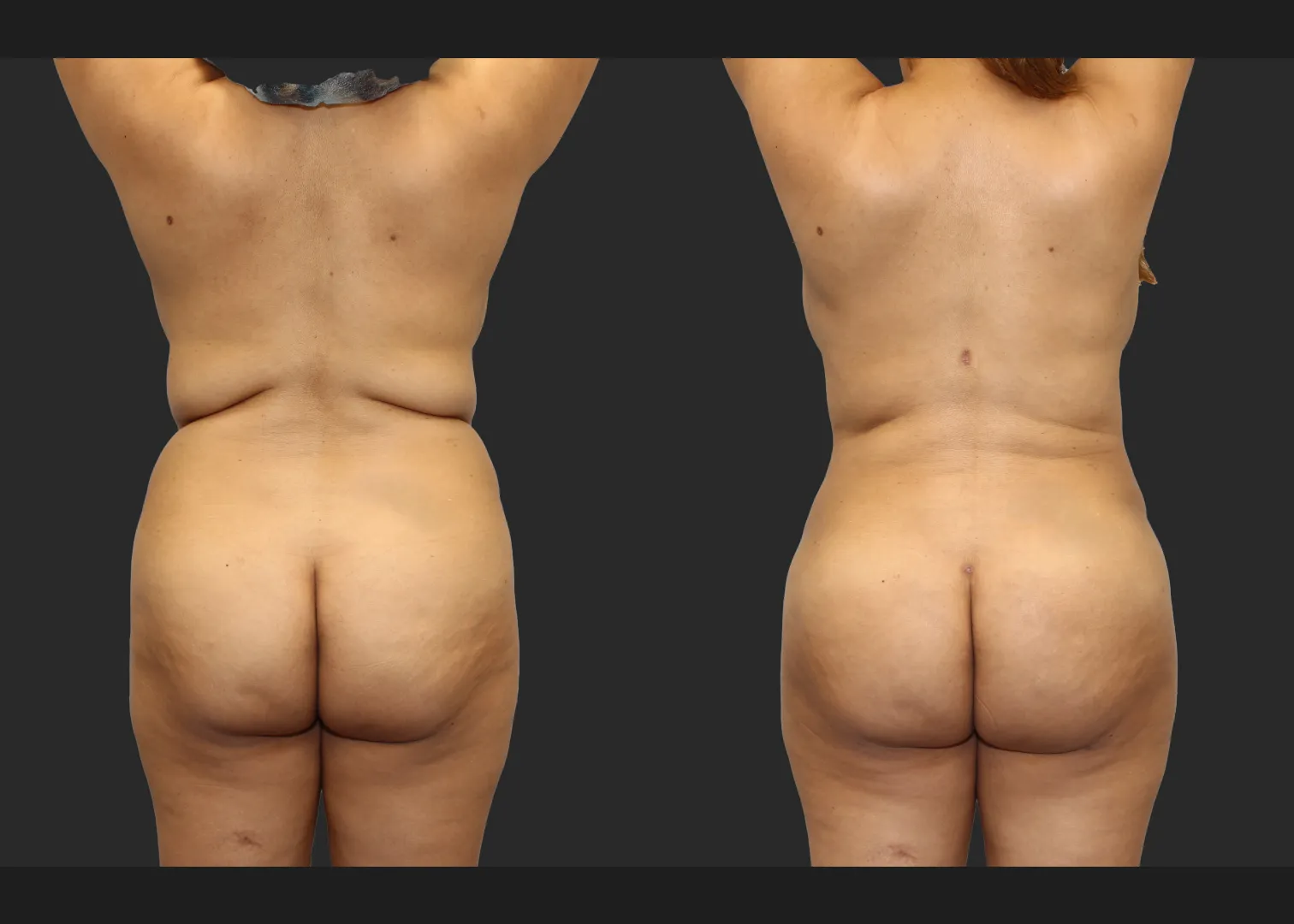 Back Arm Lipo Renuvion BBL Fat transfer to buttocks Before After – Back arms up