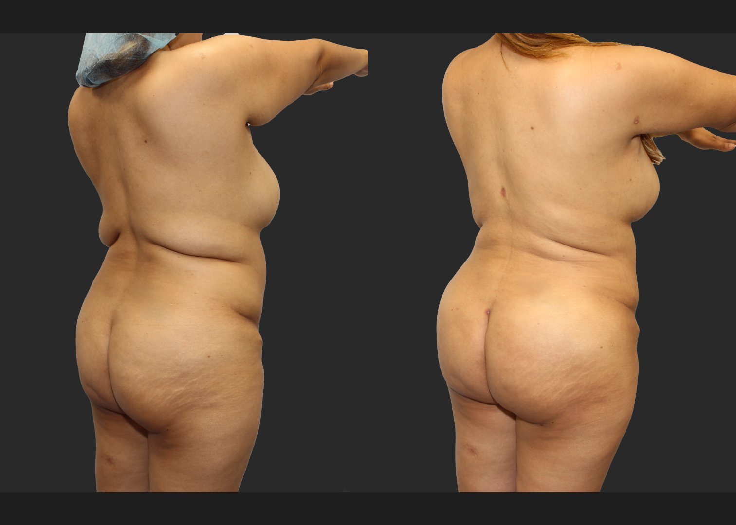 Back Arm Lipo Renuvion BBL Fat transfer to buttocks Before After – Back right oblique