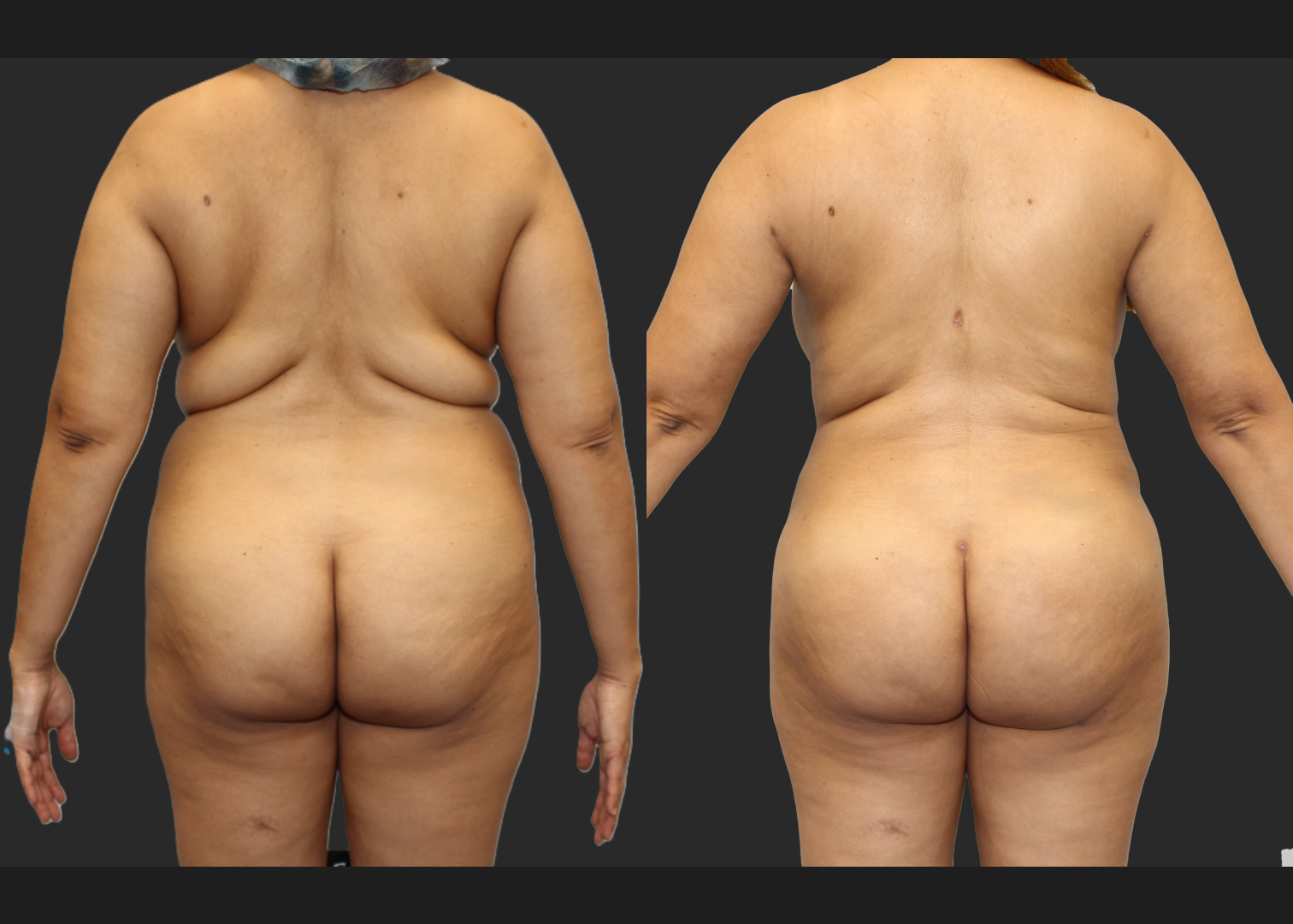 Back Arm Lipo Renuvion BBL Fat transfer to buttocks Before After – Back