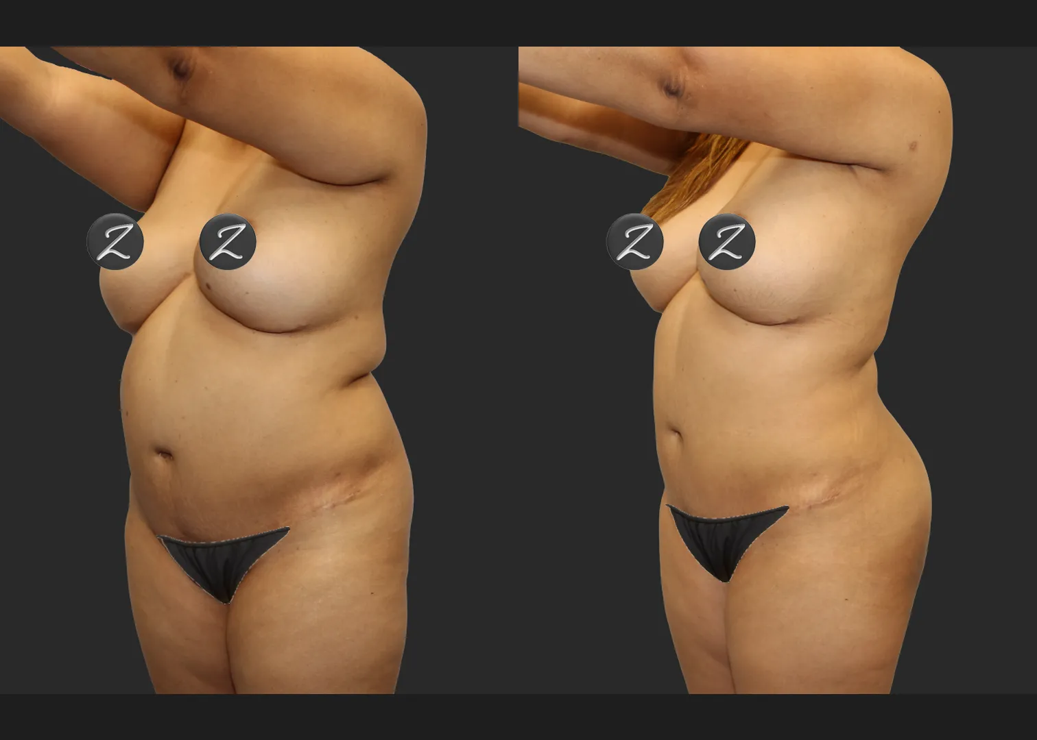 Back Arm Lipo Renuvion BBL Fat transfer to buttocks Before After – Front left oblique w covers