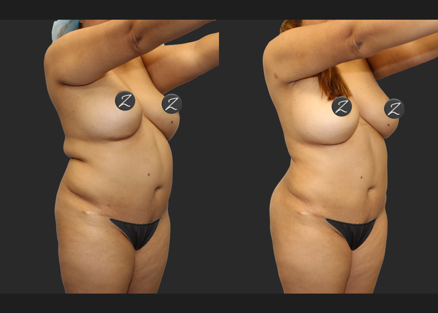 Back Arm Lipo Renuvion BBL Fat transfer to buttocks Before After – Front right oblique – w covers