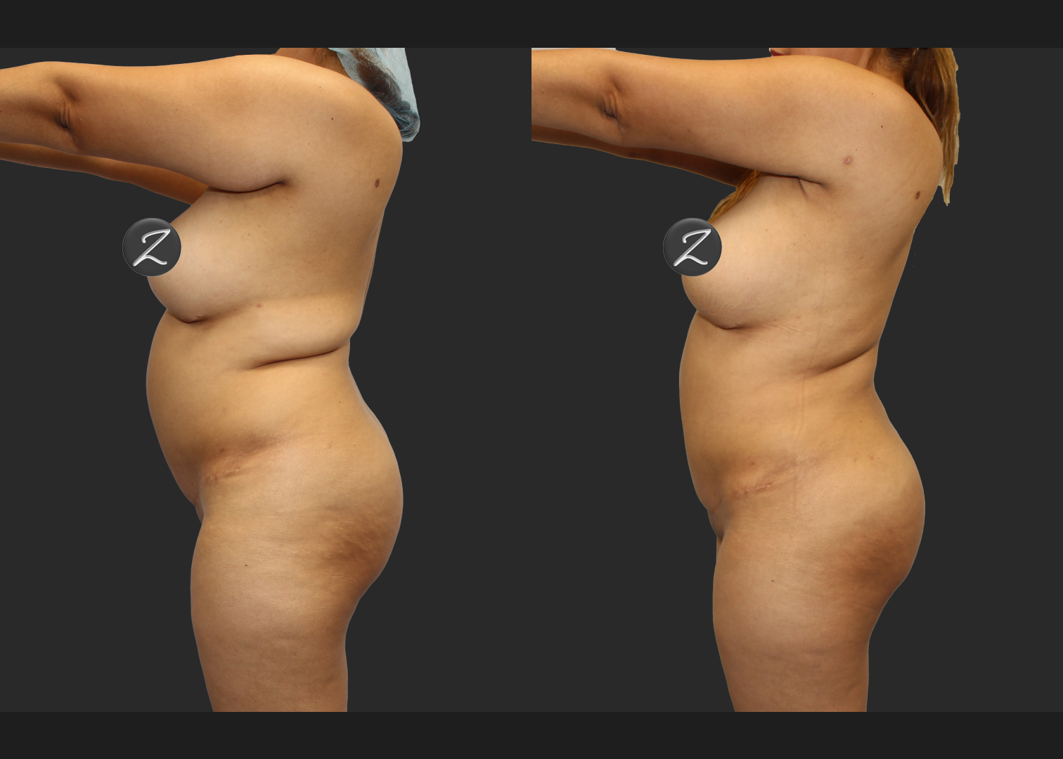 Back Arm Lipo Renuvion BBL Fat transfer to buttocks Before After – left w covers