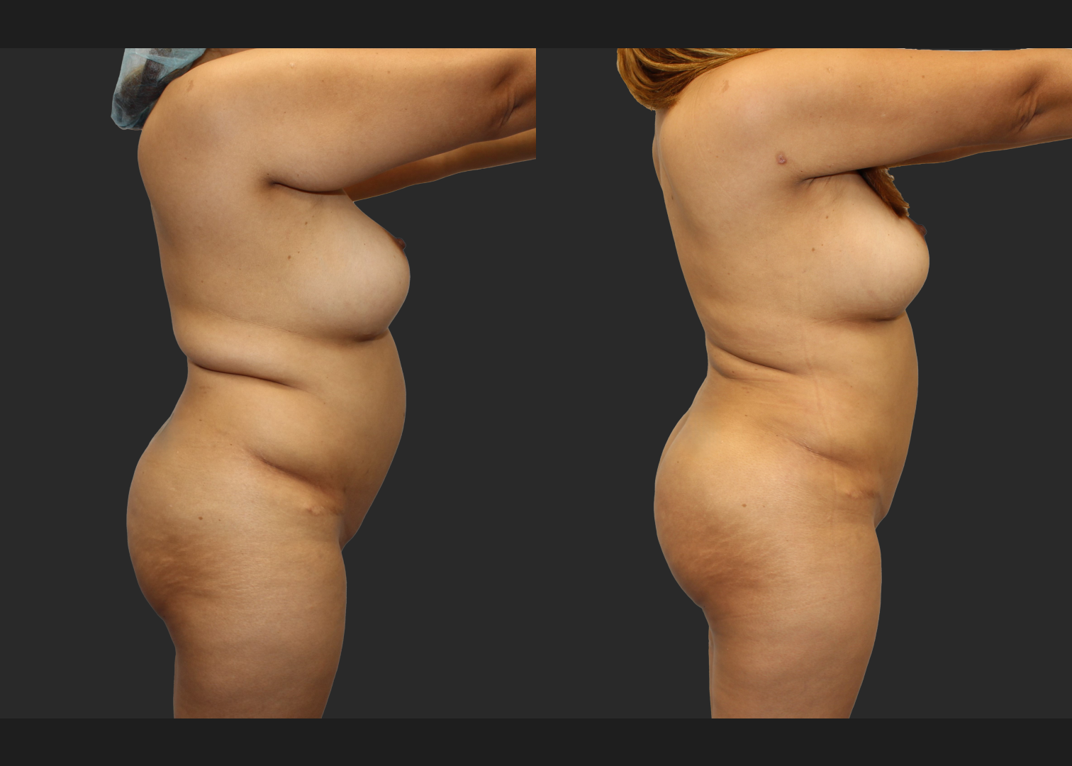 Back Arm Lipo Renuvion BBL Fat transfer to buttocks Before After – right