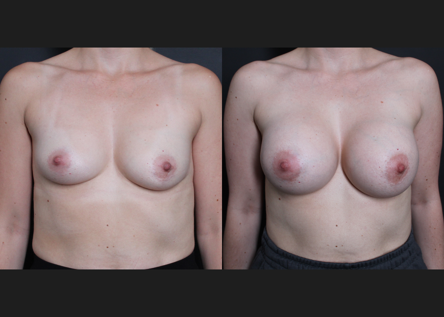 Breast Augmentation Gummy Bear Cohesive Silicone Gel implants Natrelle Smooth Round Extra Full Profile SSX 420 cc Subpectoral Dual Plane I Before After- Front