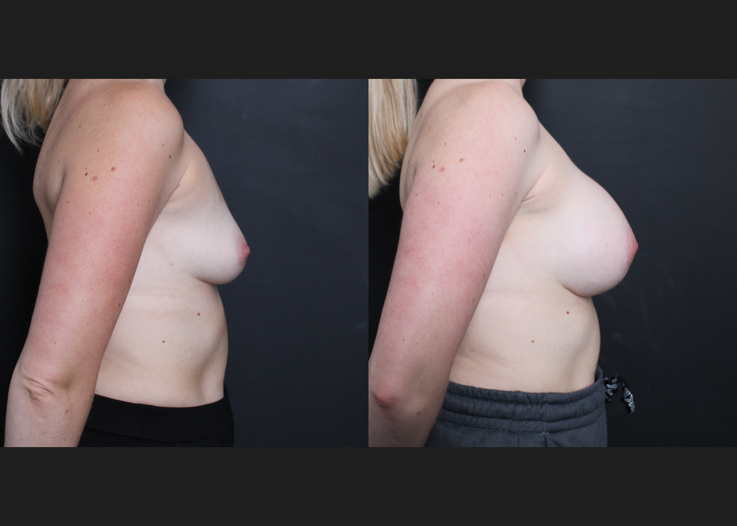 Breast Augmentation Gummy Bear Cohesive Silicone Gel implants Natrelle Smooth Round Extra Full Profile SSX 420 cc Subpectoral Dual Plane I Before After- right