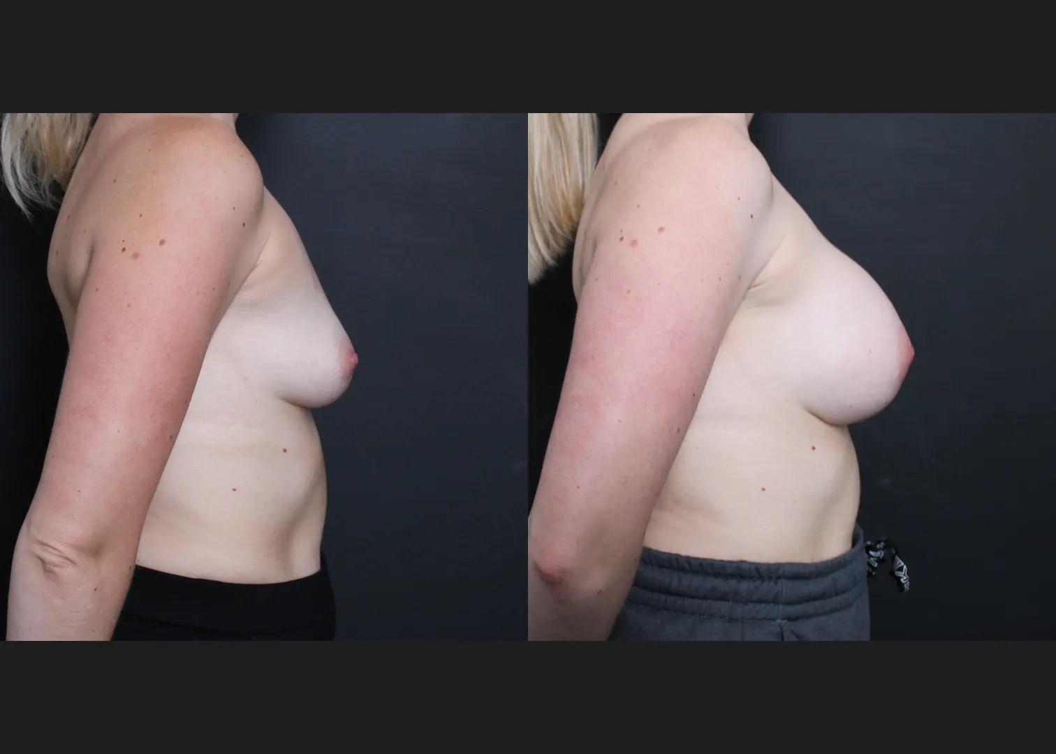 Breast Augmentation Gummy Bear Cohesive Silicone Gel implants Natrelle Smooth Round Extra Full Profile SSX 420 cc Subpectoral Dual Plane I Before After- right