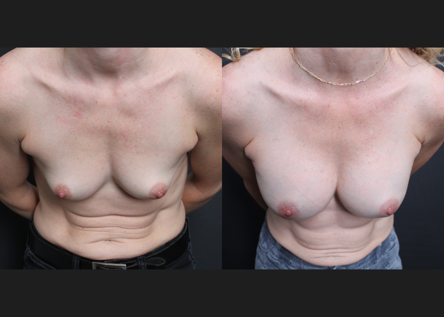 Breast Augmentation Gummy Bear Cohesive Silicone Gel implants Natrelle Smooth Round Moderate Profile SSM 255 cc Subpectoral Dual Plane I Thin Athletic Female Before After- Cleavage
