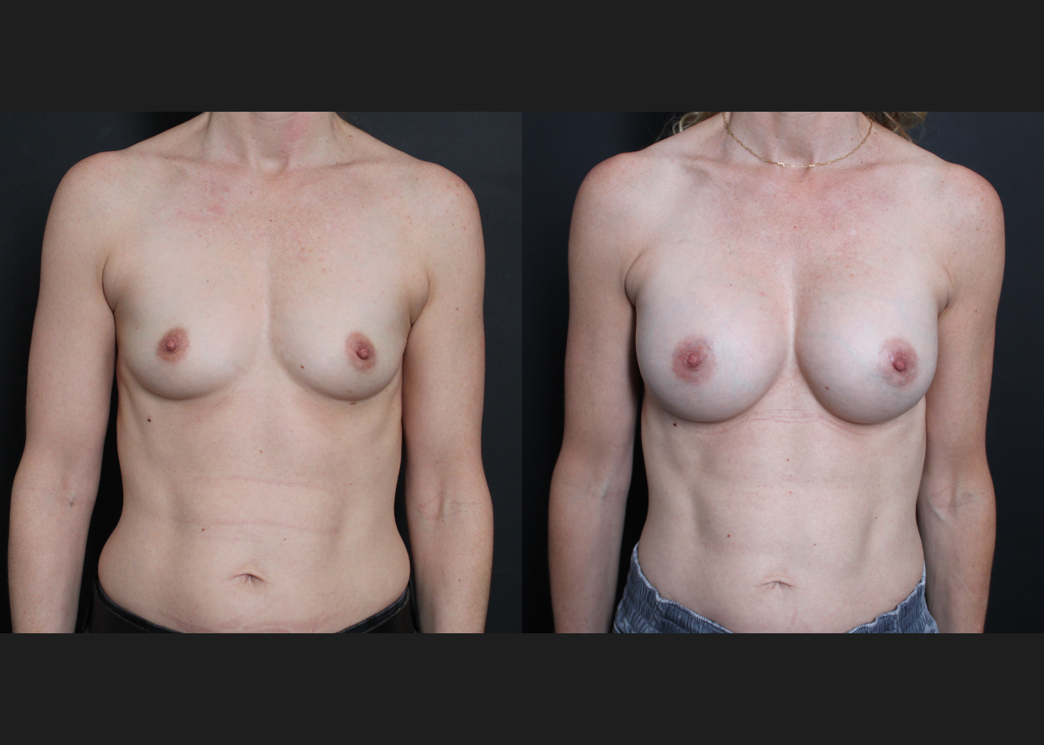 Breast Augmentation Gummy Bear Cohesive Silicone Gel implants Natrelle Smooth Round Moderate Profile SSM 255 cc Subpectoral Dual Plane I Thin Athletic Female Before After- Front