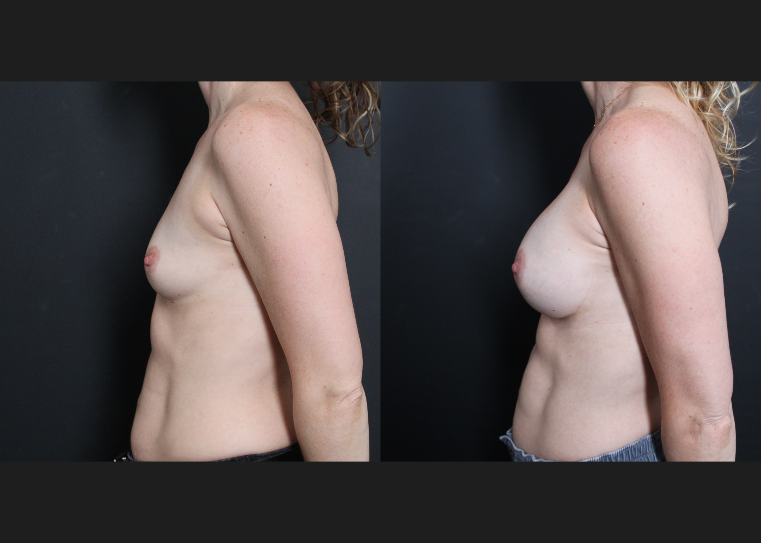 Breast Augmentation Gummy Bear Cohesive Silicone Gel implants Natrelle Smooth Round Moderate Profile SSM 255 cc Subpectoral Dual Plane I Thin Athletic Female Before After- Left