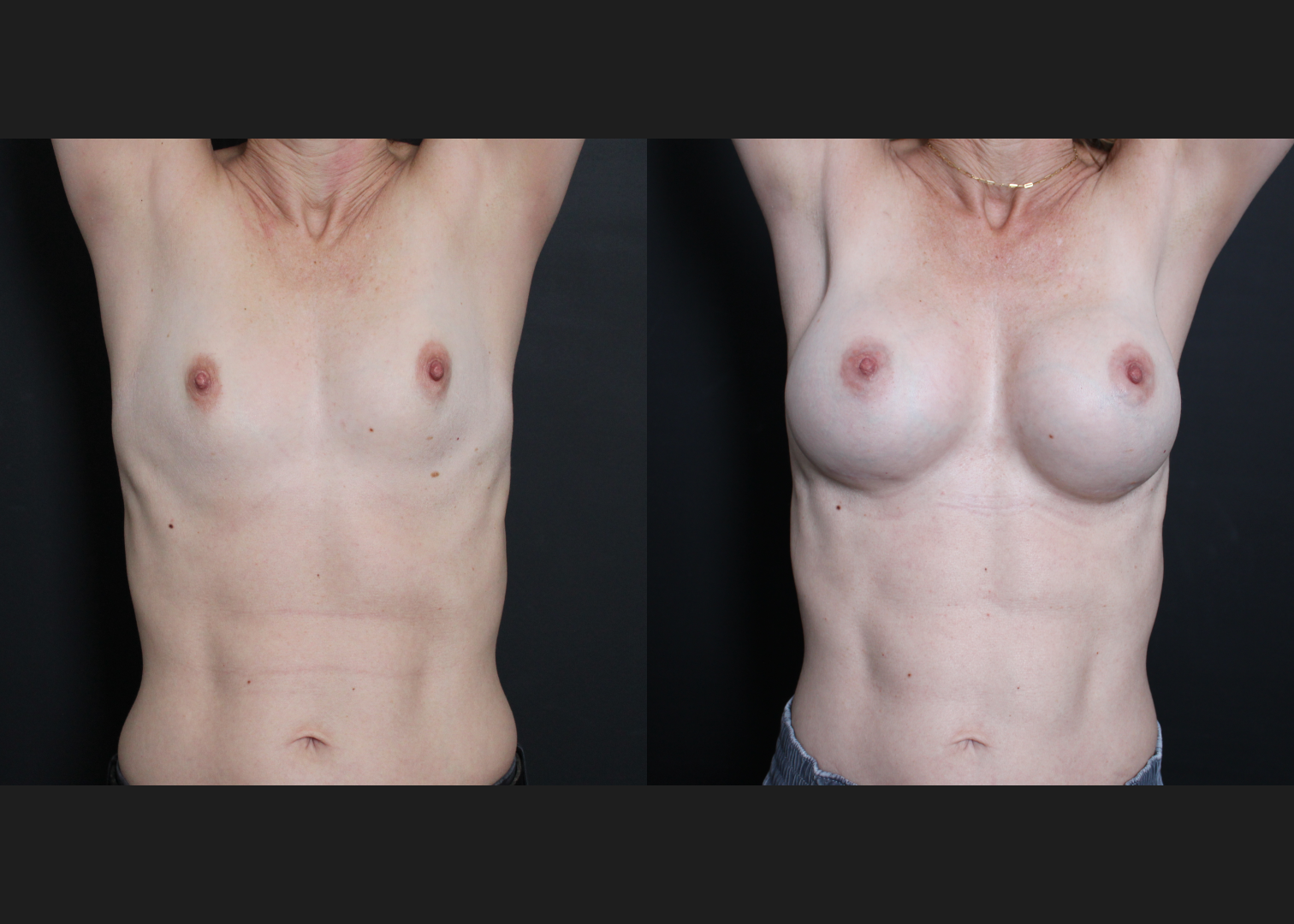 Breast Augmentation Gummy Bear Cohesive Silicone Gel implants Natrelle Smooth Round Moderate Profile SSM 255 cc Subpectoral Dual Plane I Thin Athletic Female Before After- scars