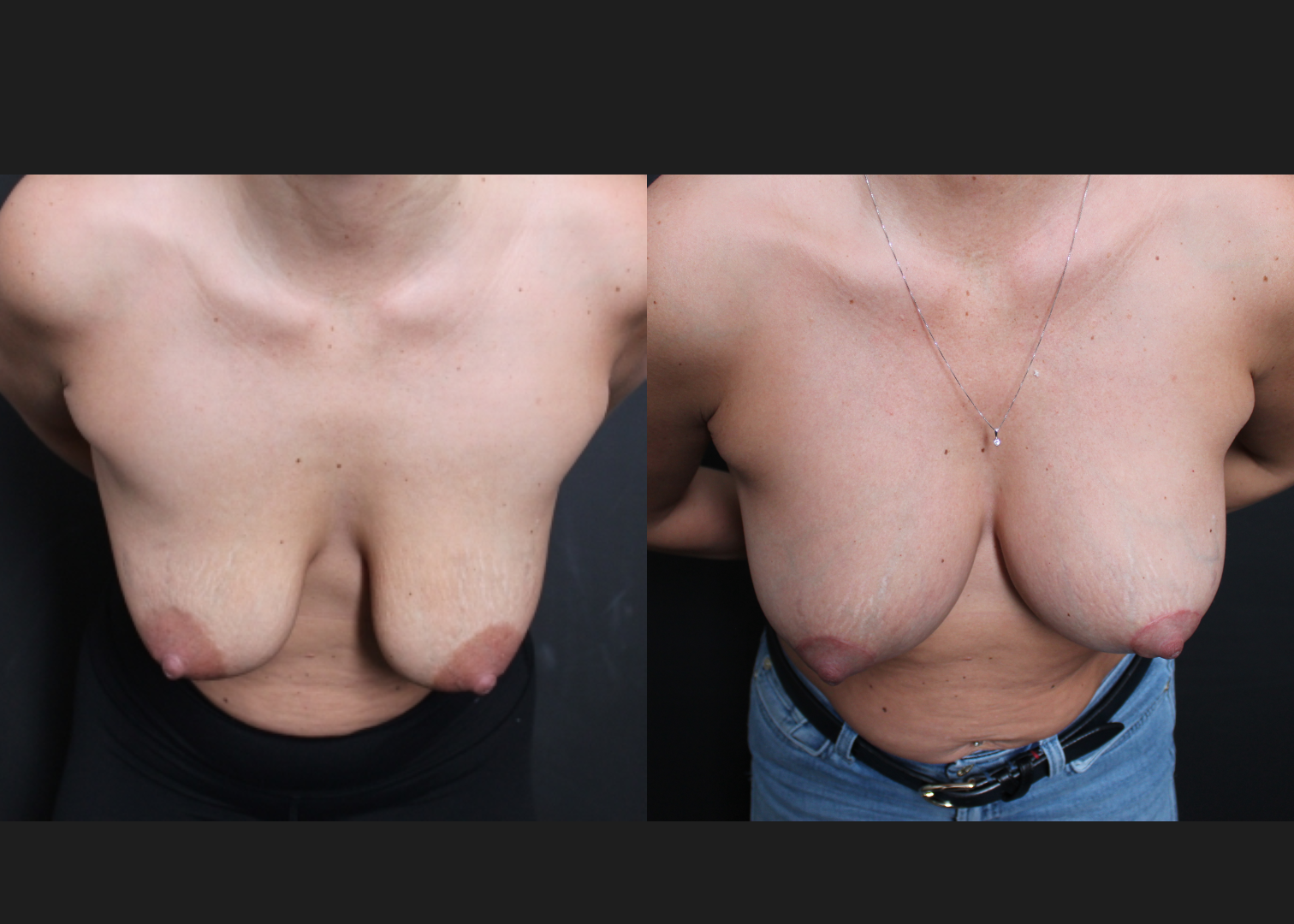 Breast Augmentation Mastopexy Sientra HSC+ moderate profile 270 cc silicone gel gummy bear implants subfascial lollipop lift before After- cleavage