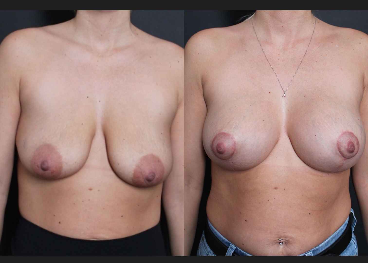 Breast Augmentation Mastopexy Sientra HSC+ moderate profile 270 cc silicone gel gummy bear implants subfascial lollipop lift before After- front