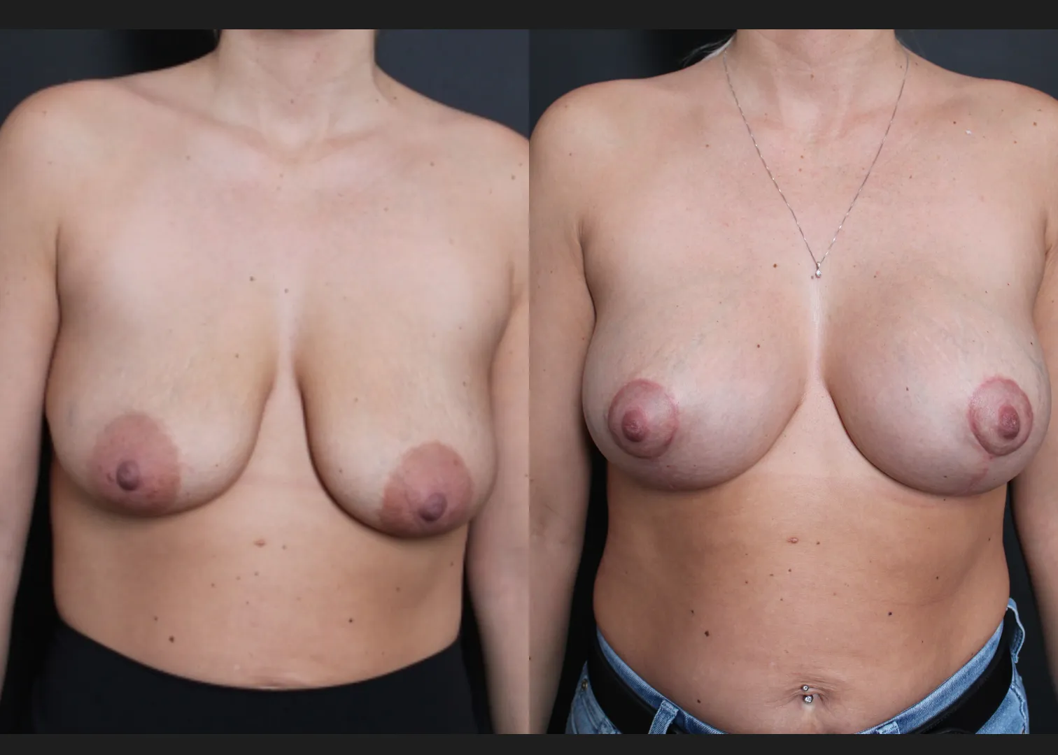 Breast Augmentation Mastopexy Sientra HSC+ moderate profile 270 cc silicone gel gummy bear implants subfascial lollipop lift before After- front