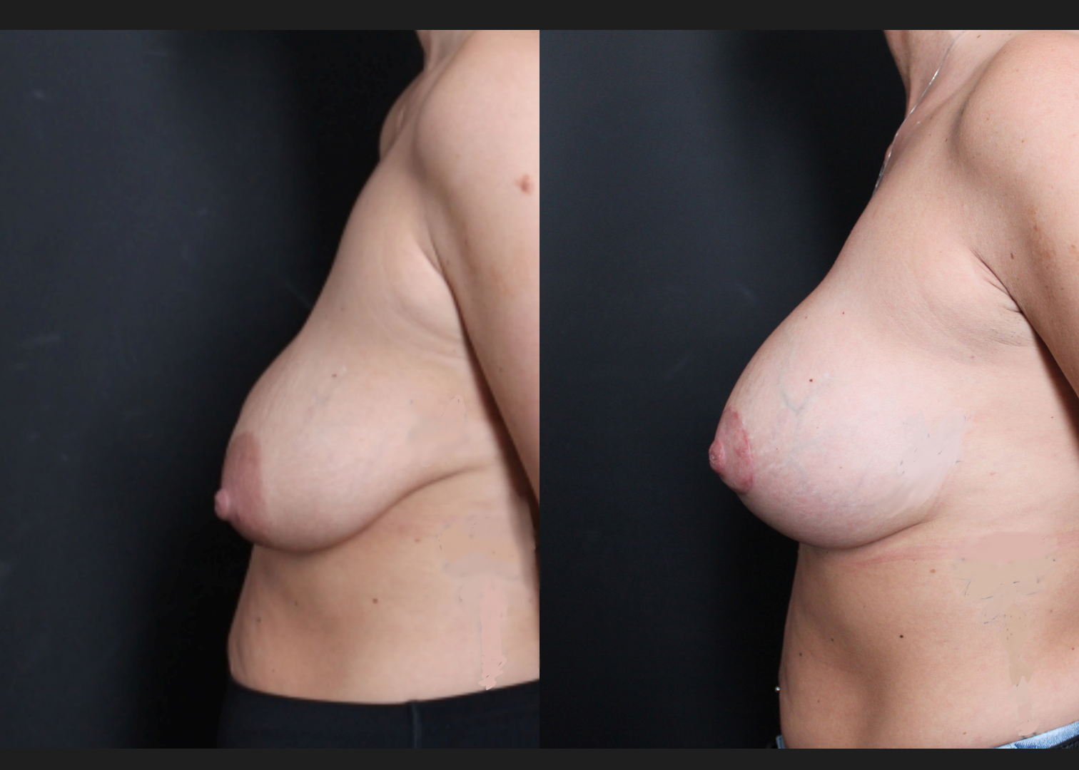 Breast Augmentation Mastopexy Sientra HSC+ moderate profile 270 cc silicone gel gummy bear implants subfascial lollipop lift before After- left