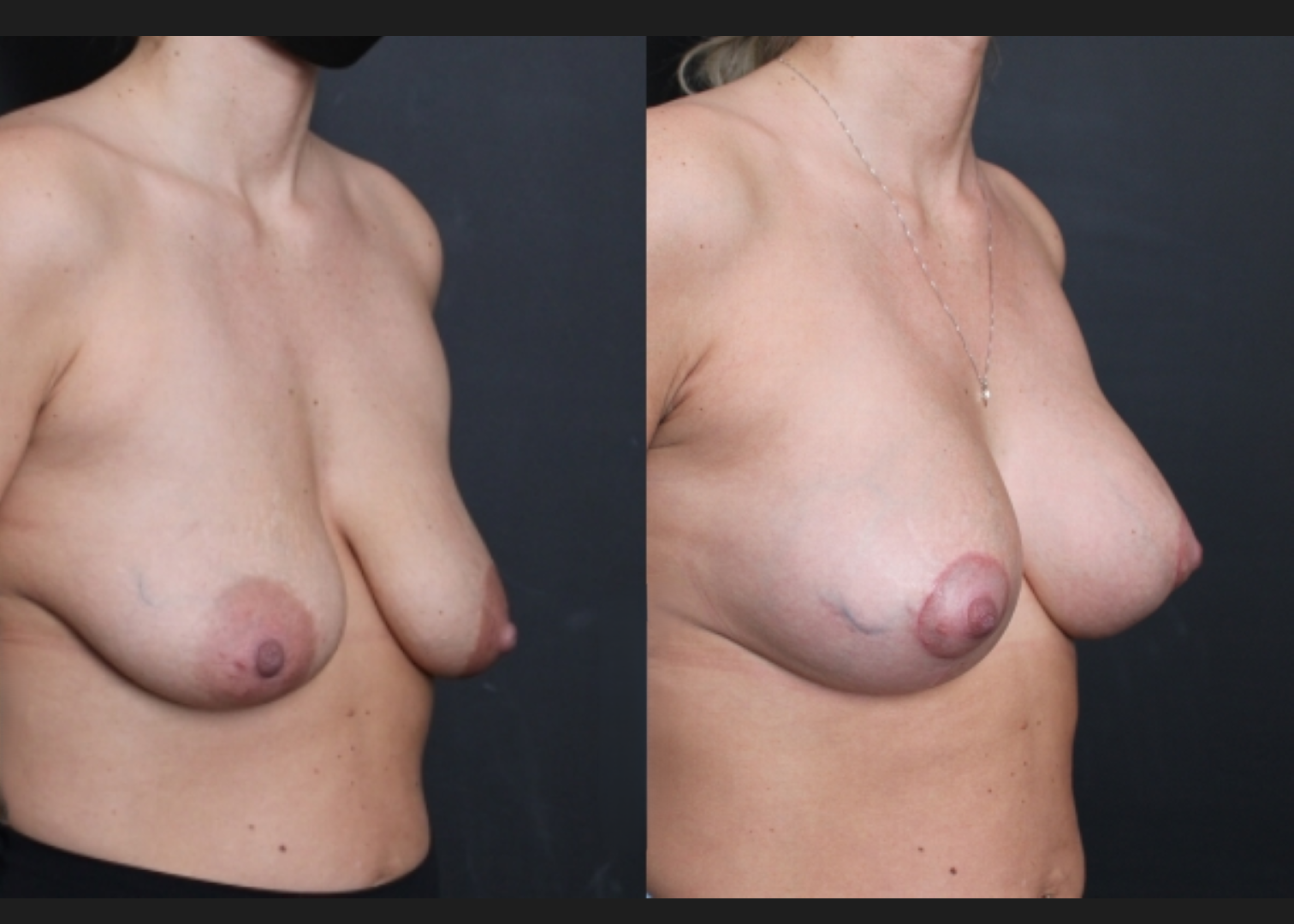 Breast Augmentation Mastopexy Sientra HSC+ moderate profile 270 cc silicone gel gummy bear implants subfascial lollipop lift before After- right oblique