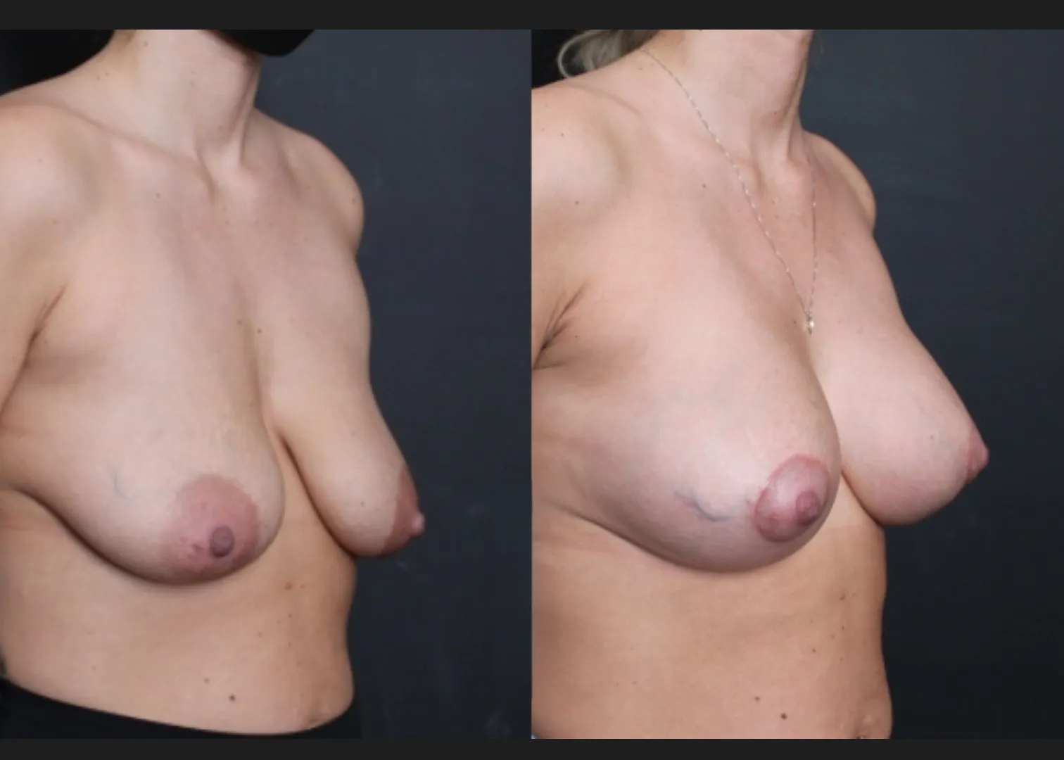 Breast Augmentation Mastopexy Sientra HSC+ moderate profile 270 cc silicone gel gummy bear implants subfascial lollipop lift before After- right oblique