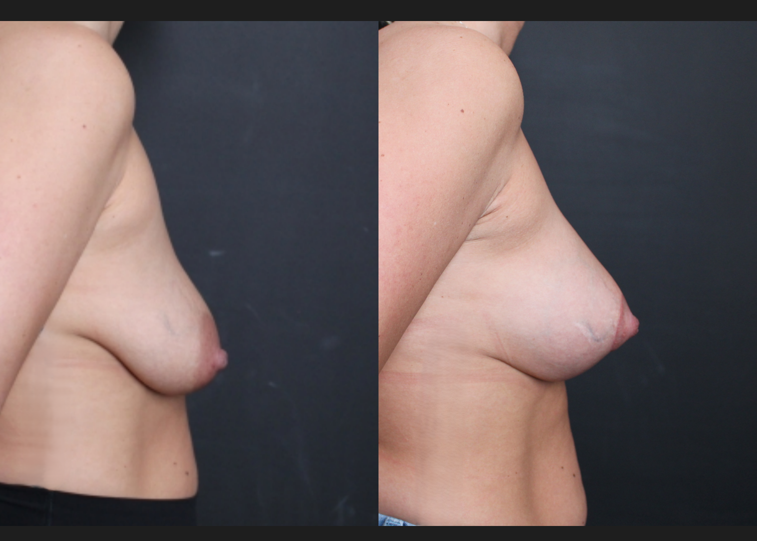 Breast Augmentation Mastopexy Sientra HSC+ moderate profile 270 cc silicone gel gummy bear implants subfascial lollipop lift before After- right