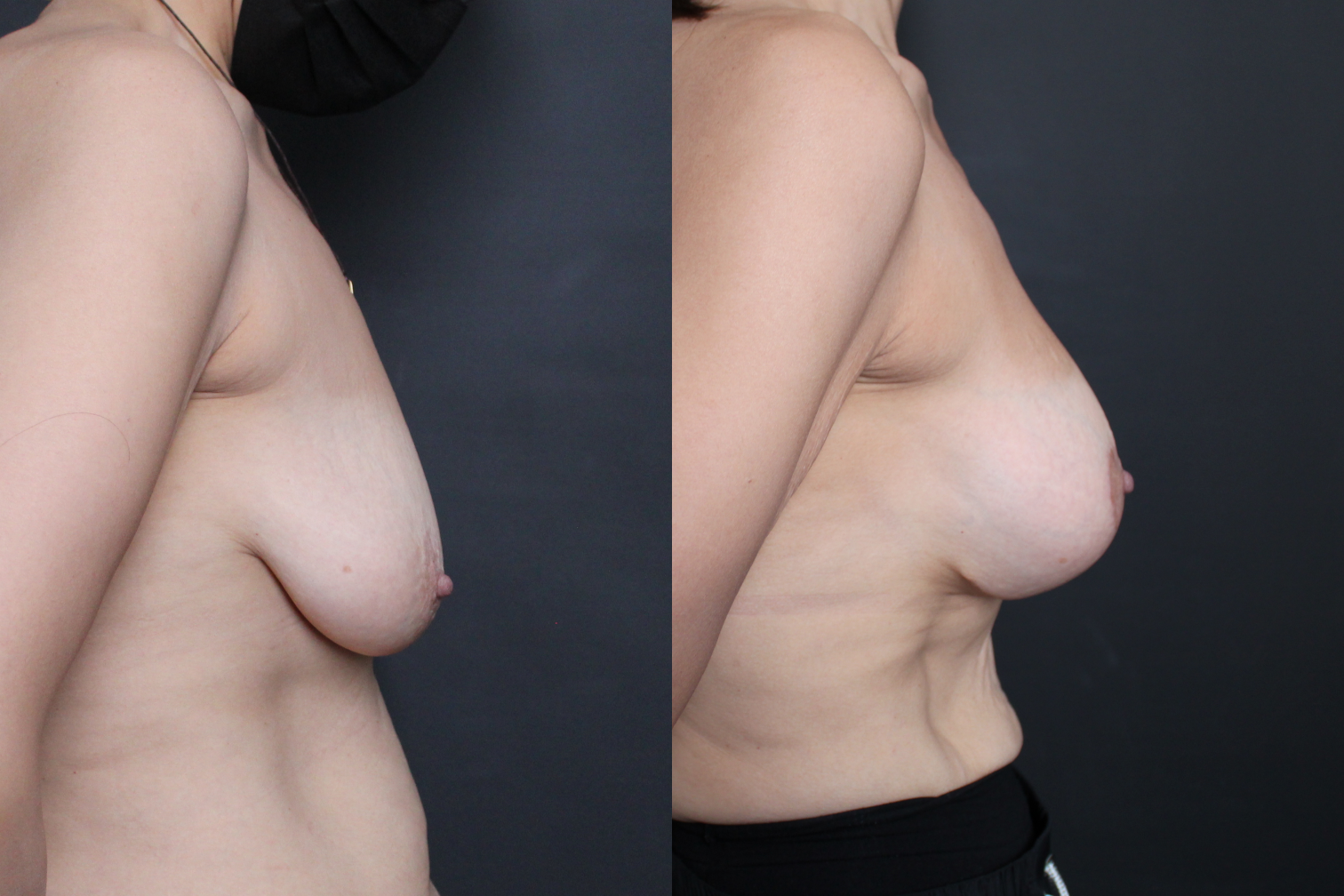 Breast Augmentation Mastopexy Sientra HSC+ moderate profile silicone gel gummy bear implanst 310 cc subfascial internal bra Galaflex scaffold Before After- right