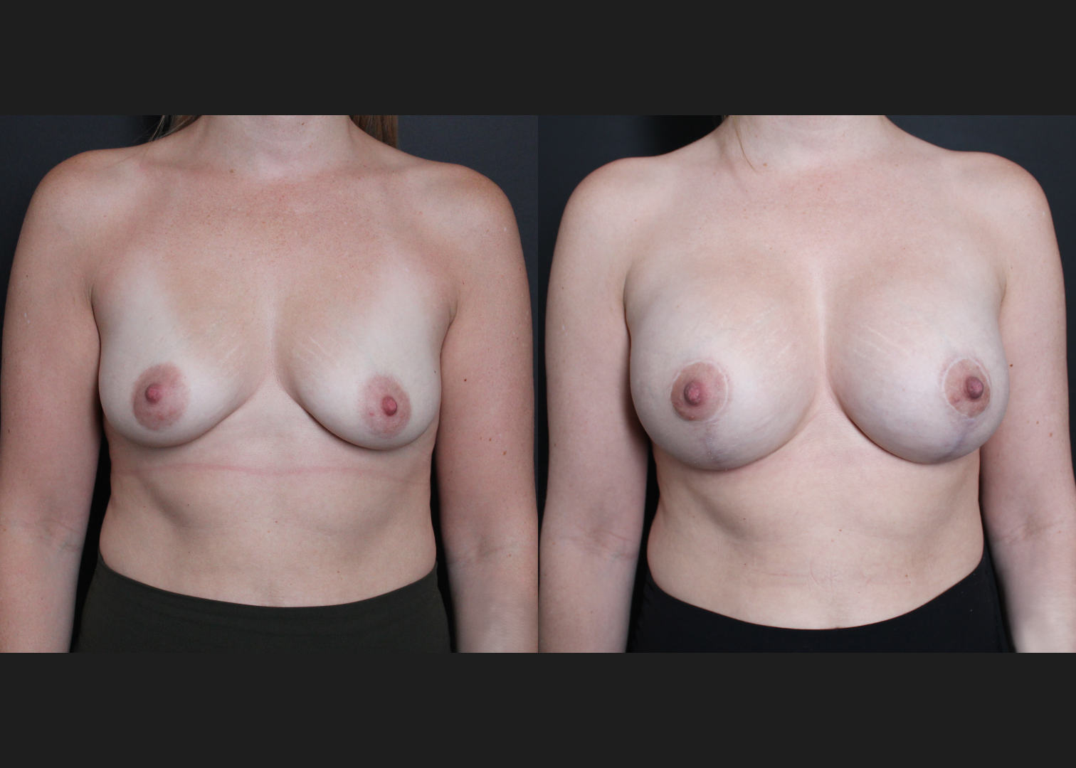 Breast Augmentation Mastopexy Sientra HSC+ smooth round moderate profile 320 cc cohesive silicone gel (gummy bear) implants subfascial lollipop lift Before After- front