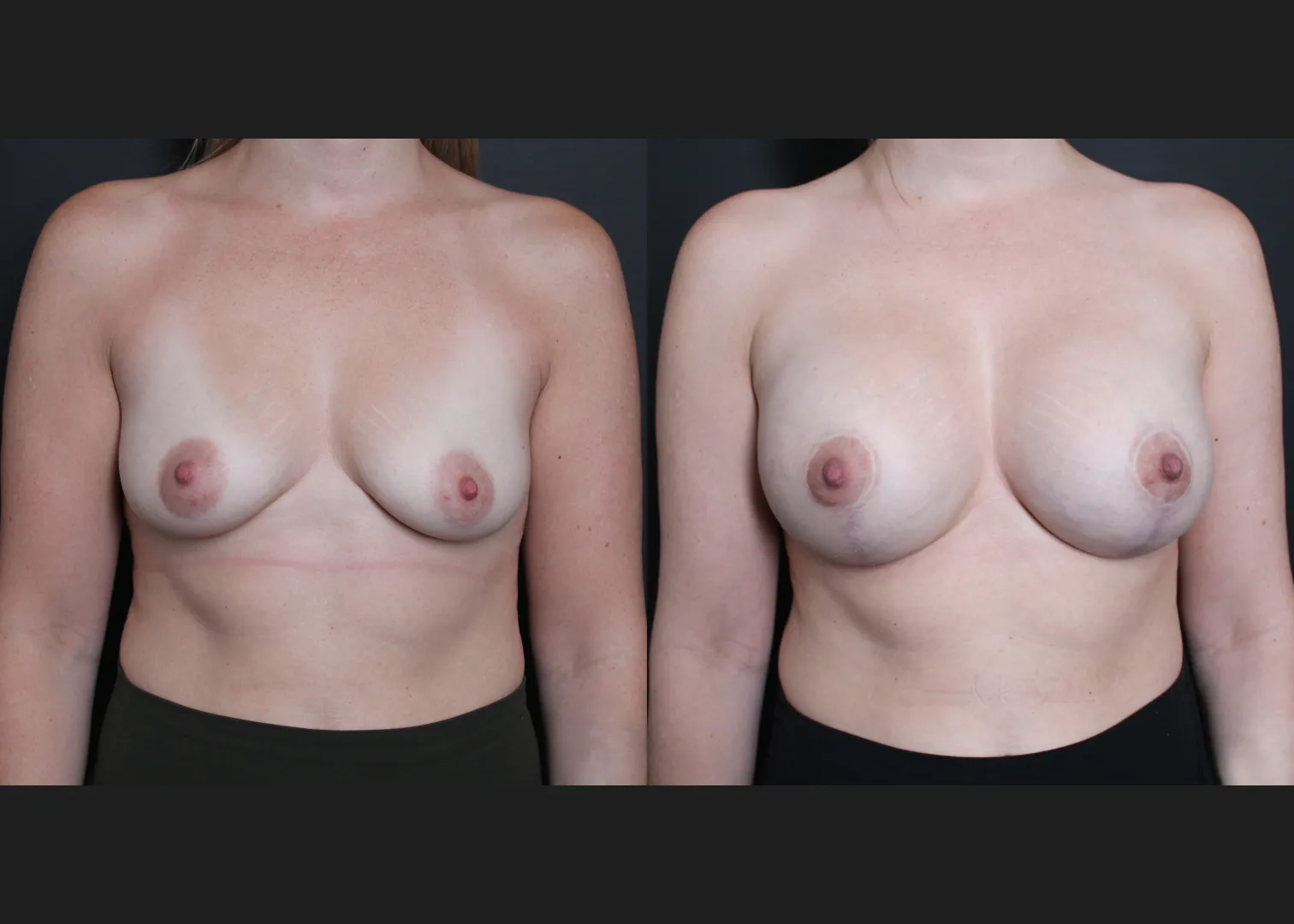 Breast Augmentation Mastopexy Sientra HSC+ smooth round moderate profile 320 cc cohesive silicone gel (gummy bear) implants subfascial lollipop lift Before After- front