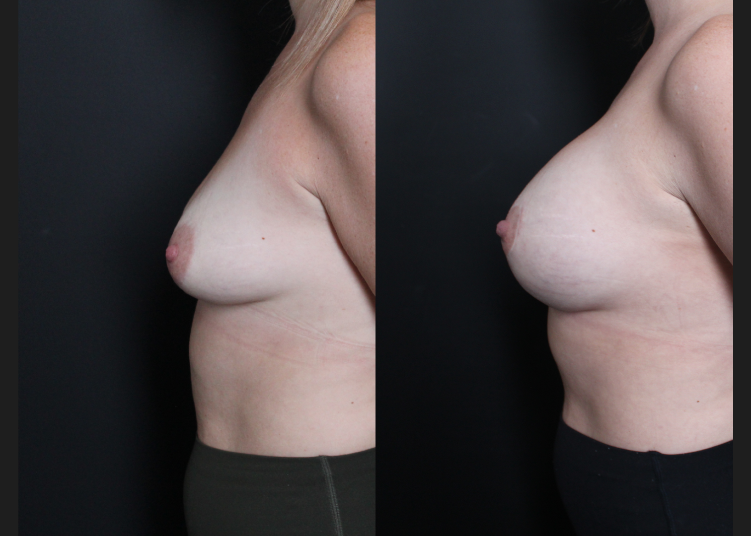 Breast Augmentation Mastopexy Sientra HSC+ smooth round moderate profile 320 cc cohesive silicone gel (gummy bear) implants subfascial lollipop lift Before After- left