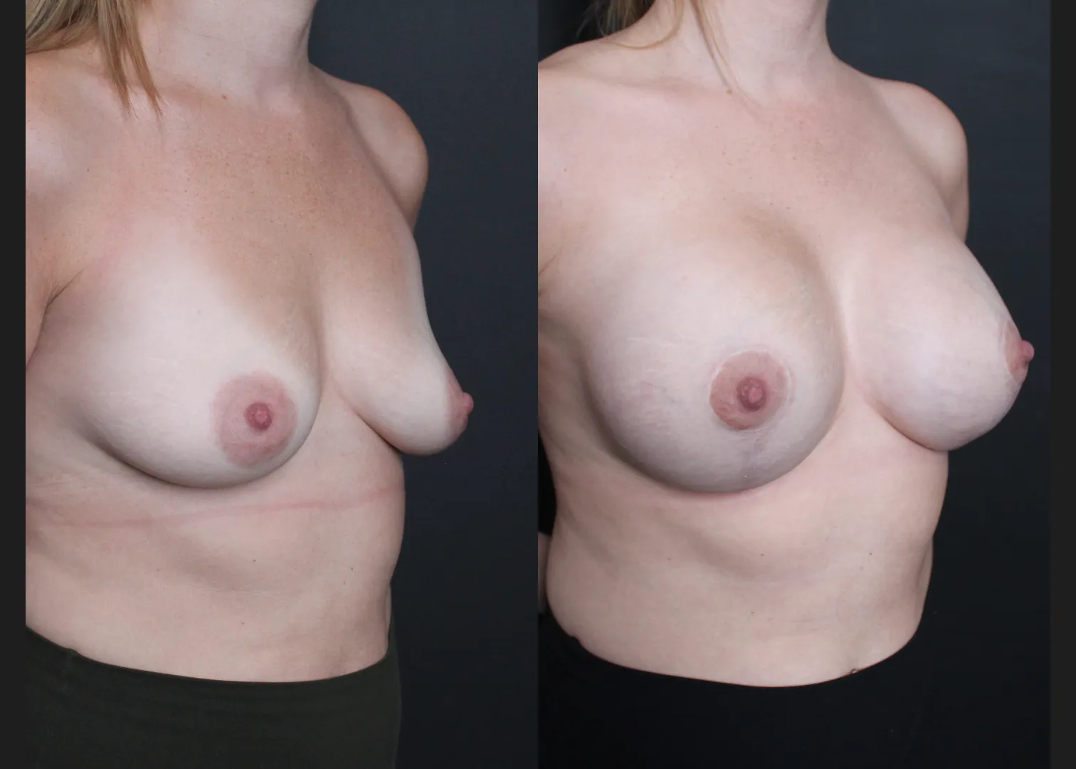 Breast Augmentation Mastopexy Sientra HSC+ smooth round moderate profile 320 cc cohesive silicone gel (gummy bear) implants subfascial lollipop lift Before After- right oblique