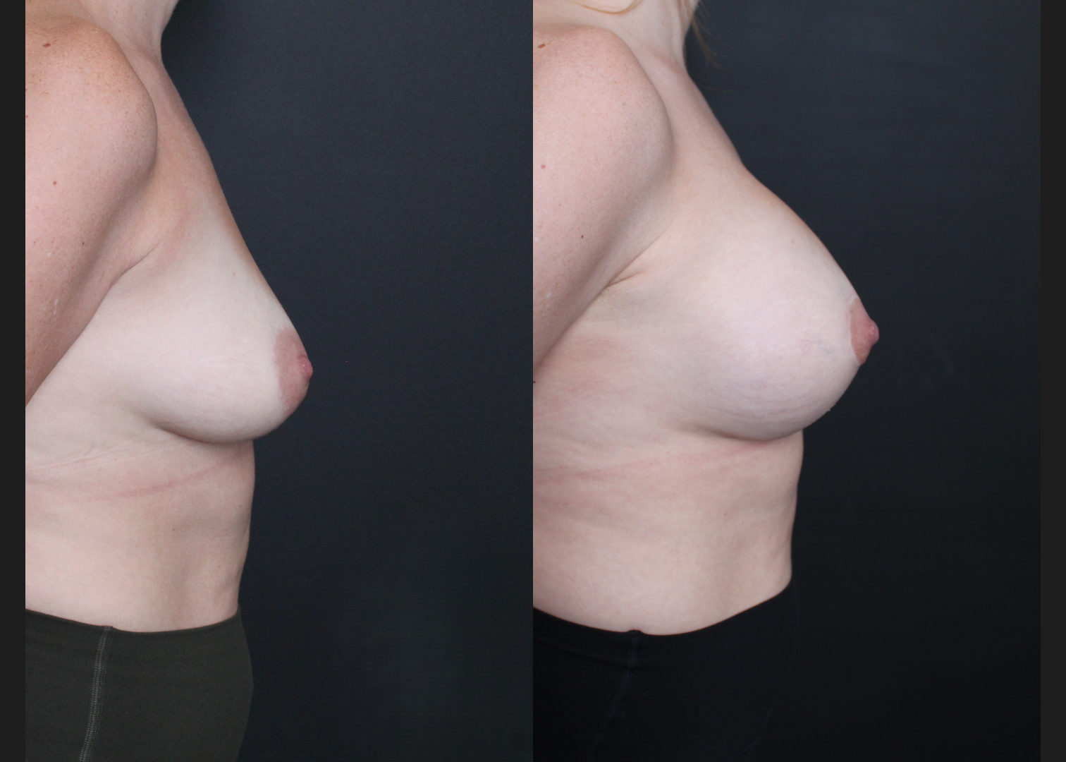 Breast Augmentation Mastopexy Sientra HSC+ smooth round moderate profile 320 cc cohesive silicone gel (gummy bear) implants subfascial lollipop lift Before After- right