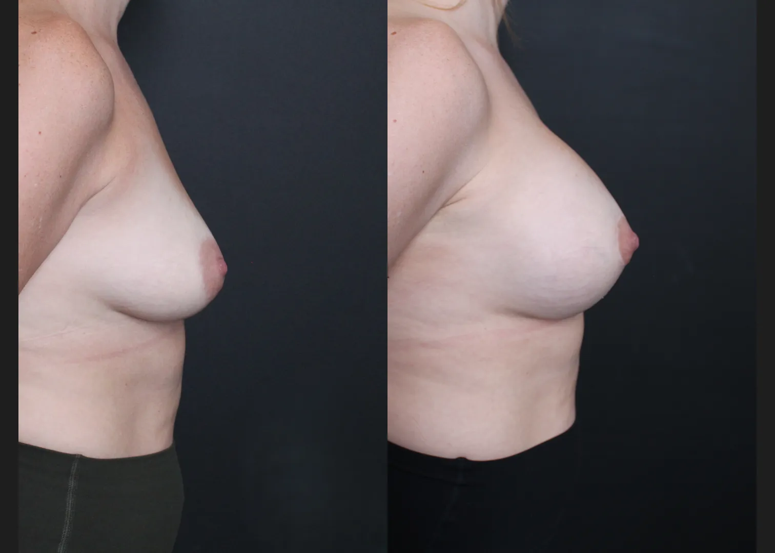 Breast Augmentation Mastopexy Sientra HSC+ smooth round moderate profile 320 cc cohesive silicone gel (gummy bear) implants subfascial lollipop lift Before After- right