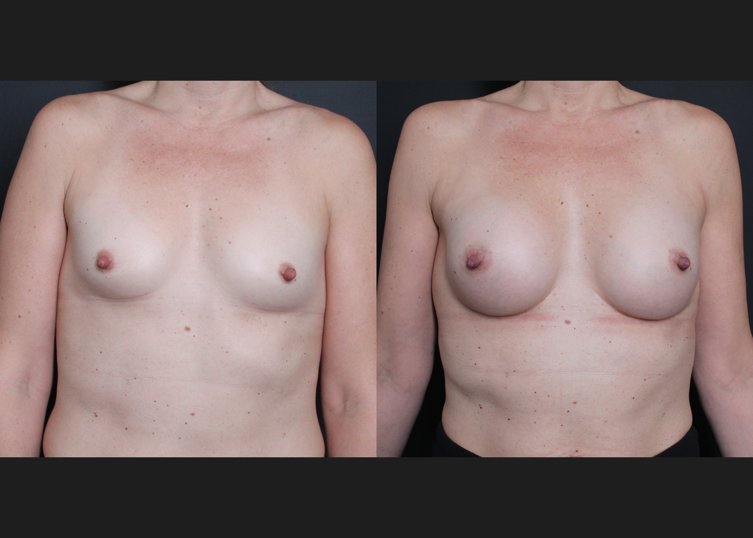 Breast Augmentation Petite Silicone cohesive gel smooth round low plus profile SSLP 220 cc subfascial Before After- Front