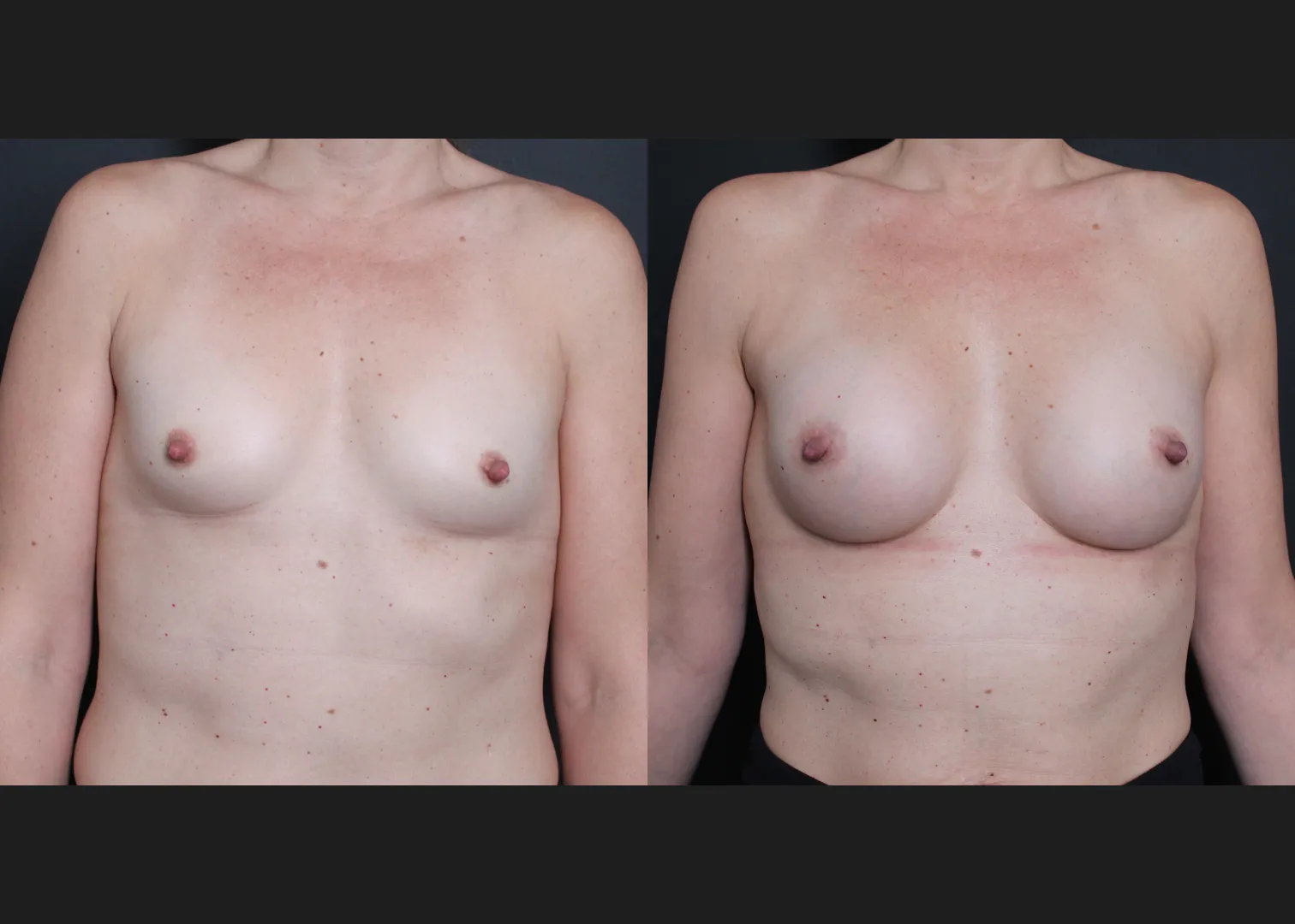 Breast Augmentation Petite Silicone cohesive gel smooth round low plus profile SSLP 220 cc subfascial Before After- Front