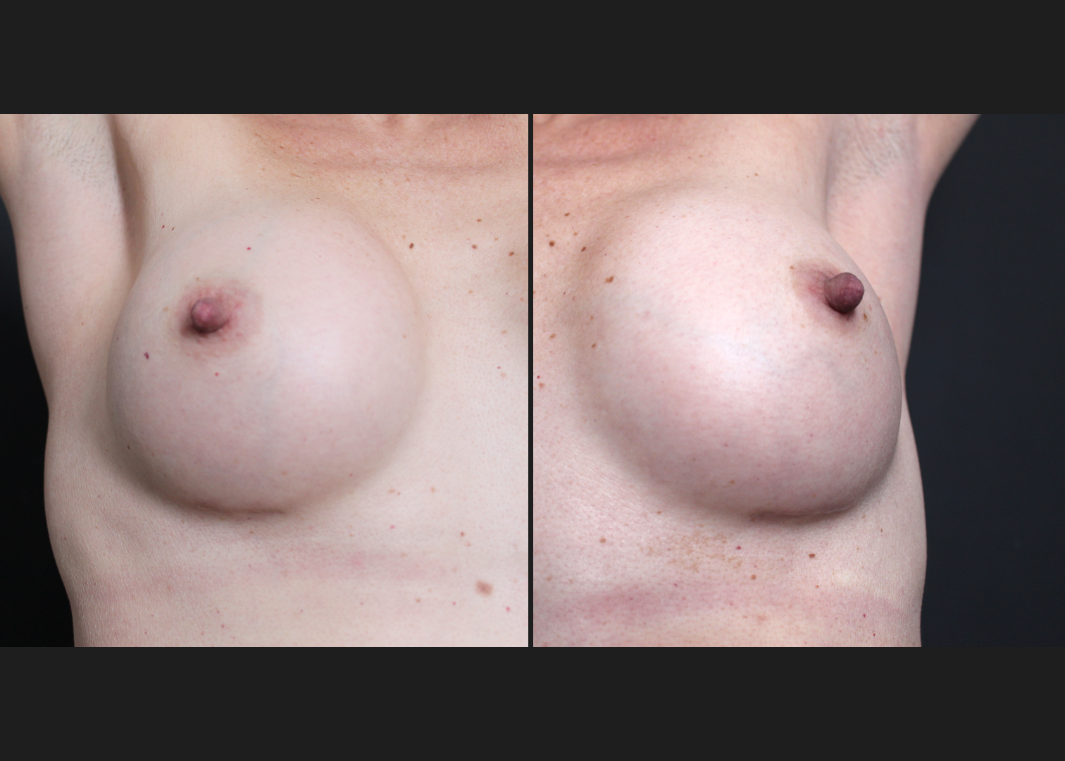 Breast Augmentation Petite Silicone cohesive gel smooth round low plus profile SSLP 220 cc subfascial Before After- IMC scars