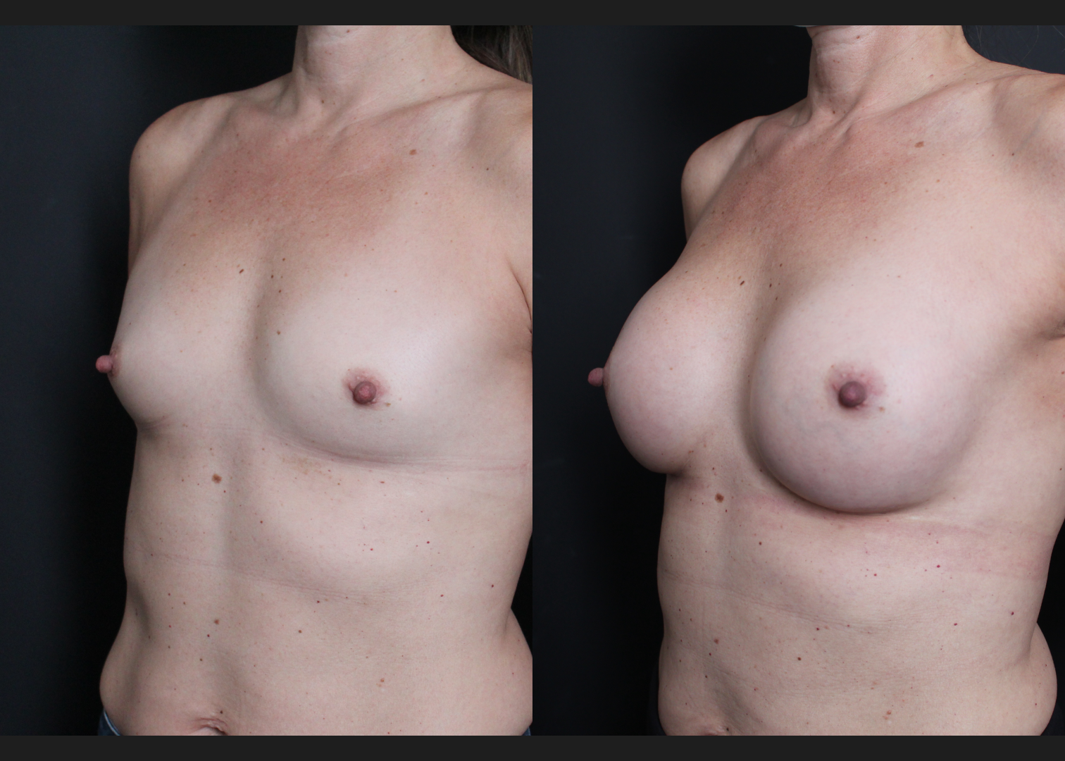 Breast Augmentation Petite Silicone cohesive gel smooth round low plus profile SSLP 220 cc subfascial Before After- Left oblique