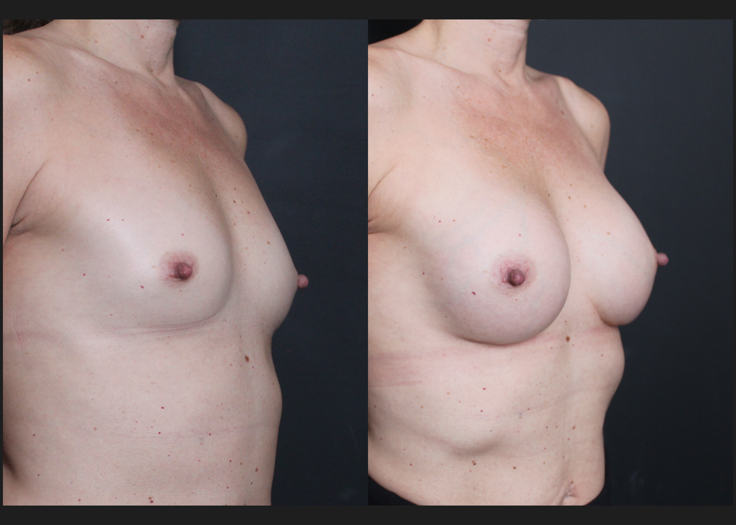 Breast Augmentation Petite Silicone cohesive gel smooth round low plus profile SSLP 220 cc subfascial Before After- Right oblique