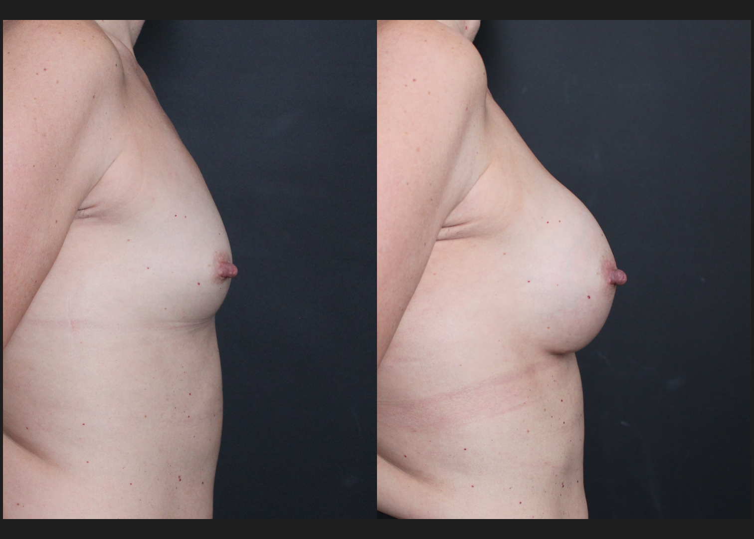 Breast Augmentation Petite Silicone cohesive gel smooth round low plus profile SSLP 220 cc subfascial Before After- Right