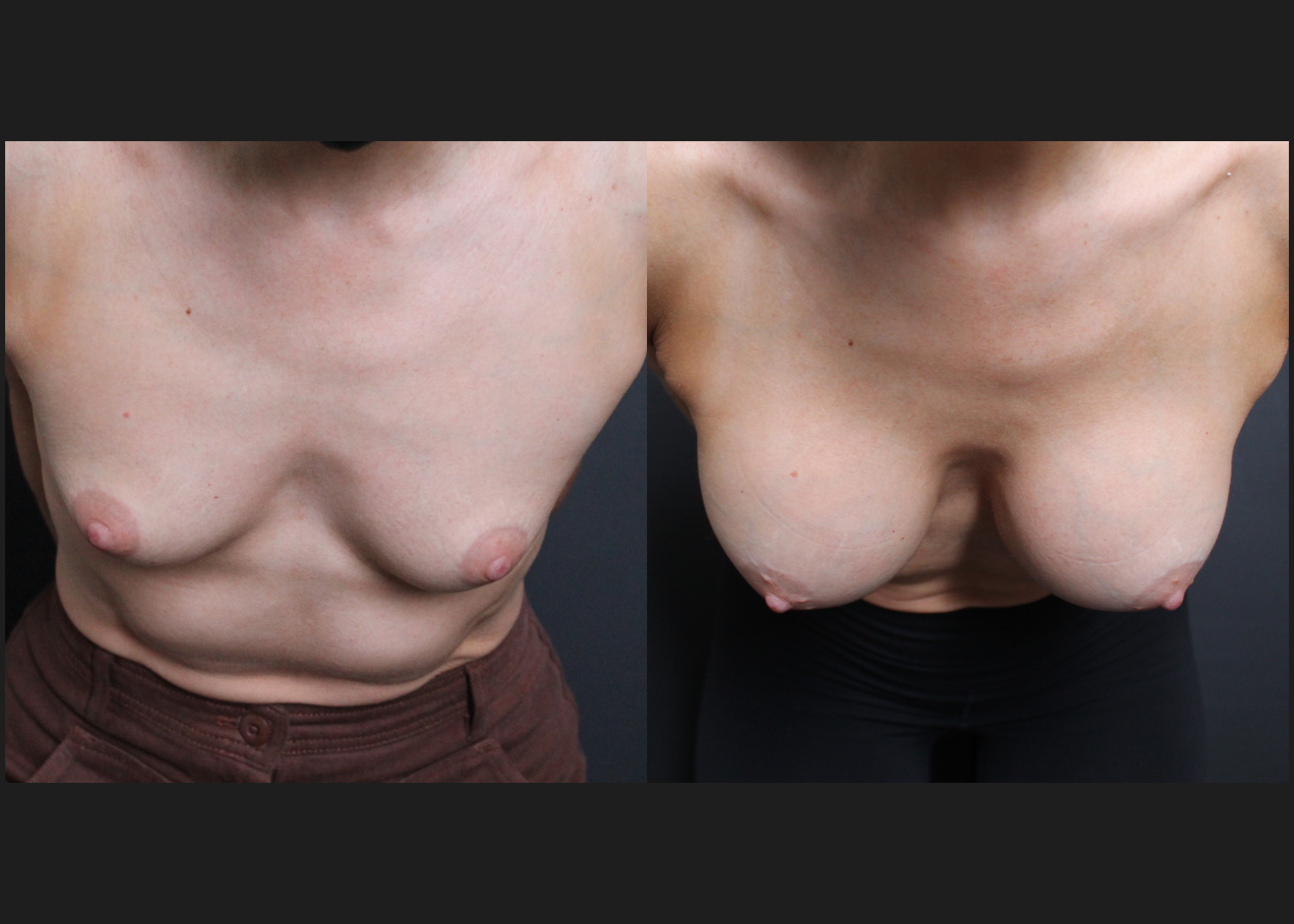 Breast Augmentation Silicone Cohesive Gel Implants Natrelle Inspira Full Profile Smooth Round SSF 295 cc Subpectoral Dual Plane Athletic Female Before After- Cleavage